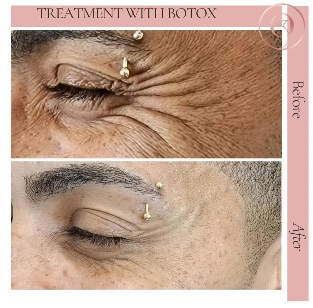 Botox antes y después, patas de gallo suavizadas