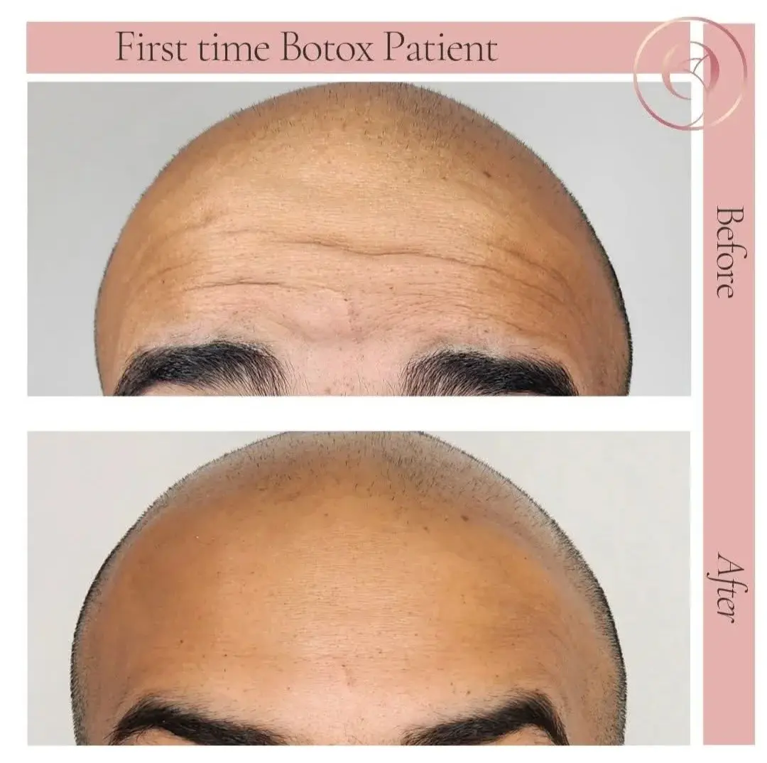 Paciente de Botox por primera vez, antes y después, líneas de la frente