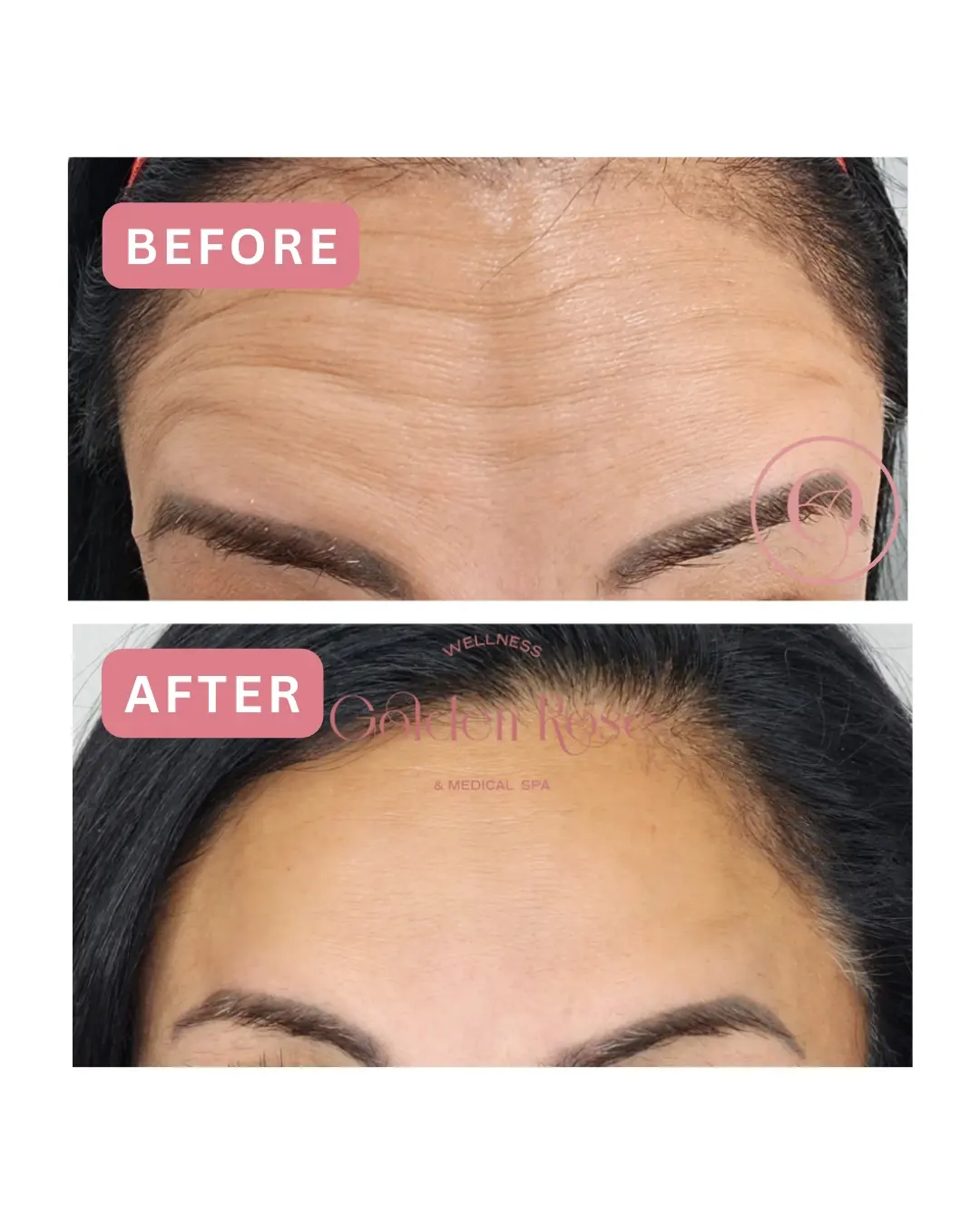 Botox antes y después, líneas de la frente suavizadas