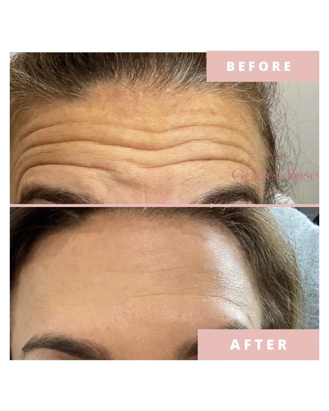 Botox antes y después, líneas profundas de la frente suavizadas