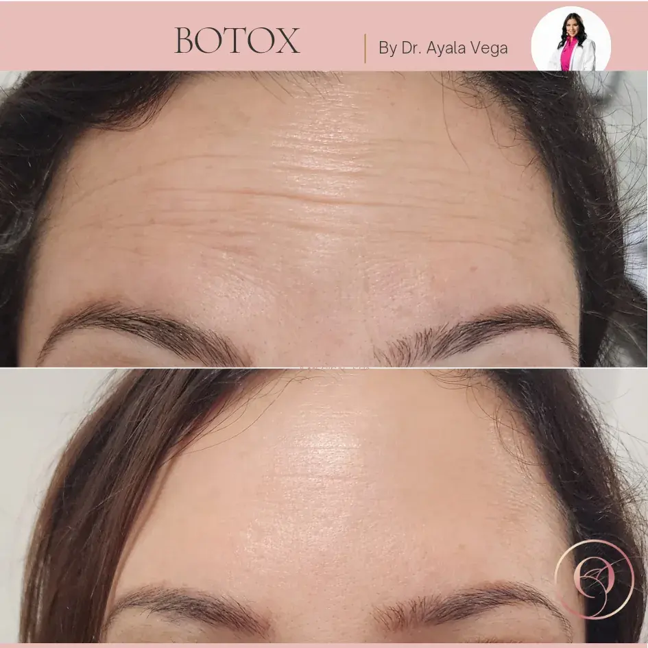 Botox antes y después, líneas de la frente