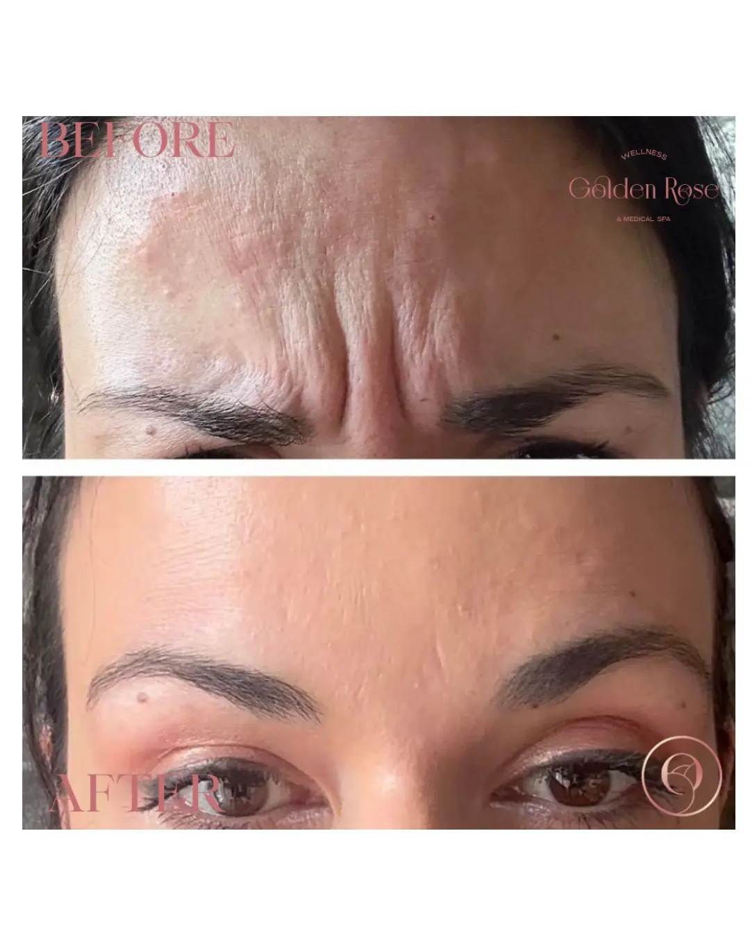 Botox antes y después, líneas de expresión del entrecejo