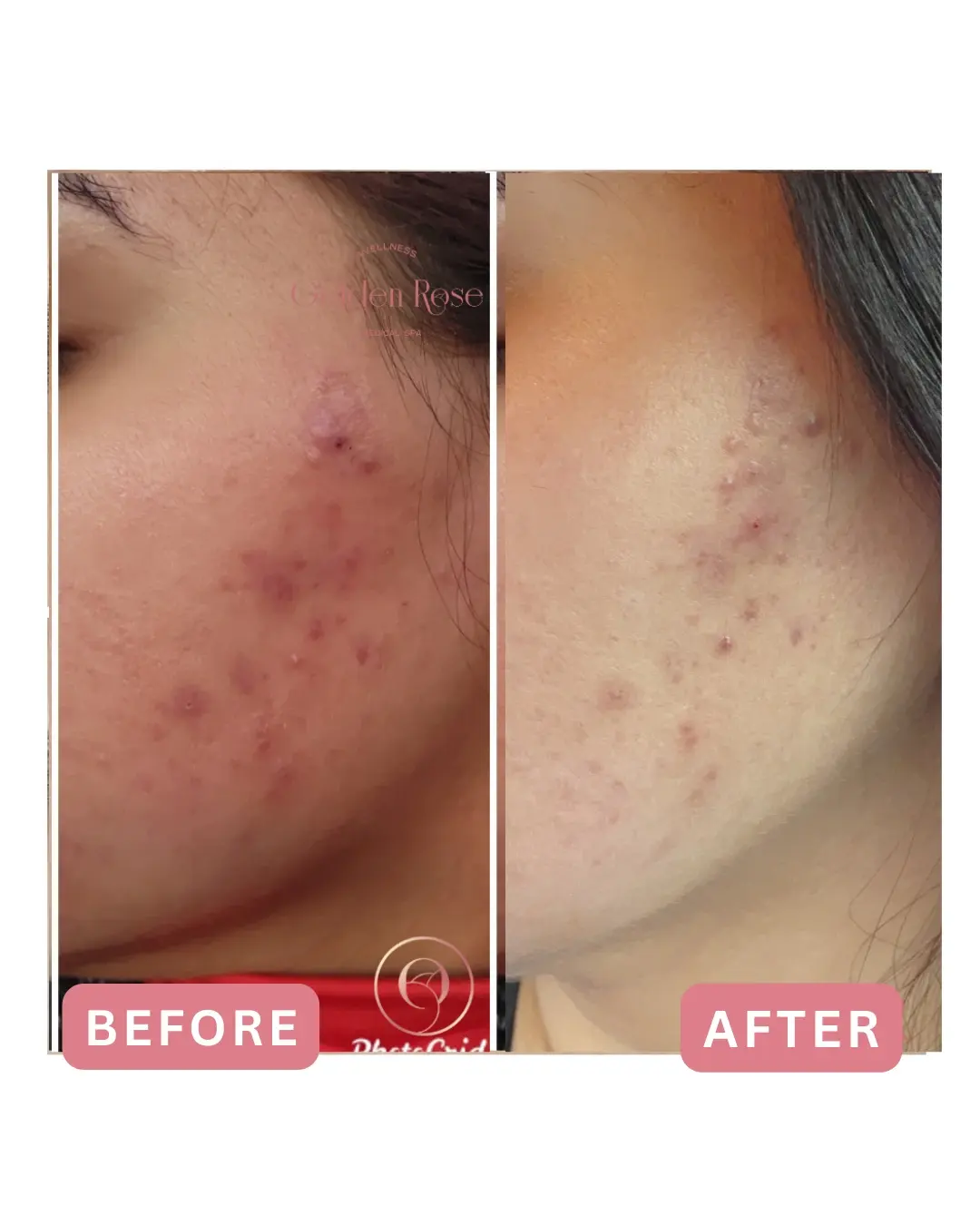 Peeling químico antes y después, acné activo