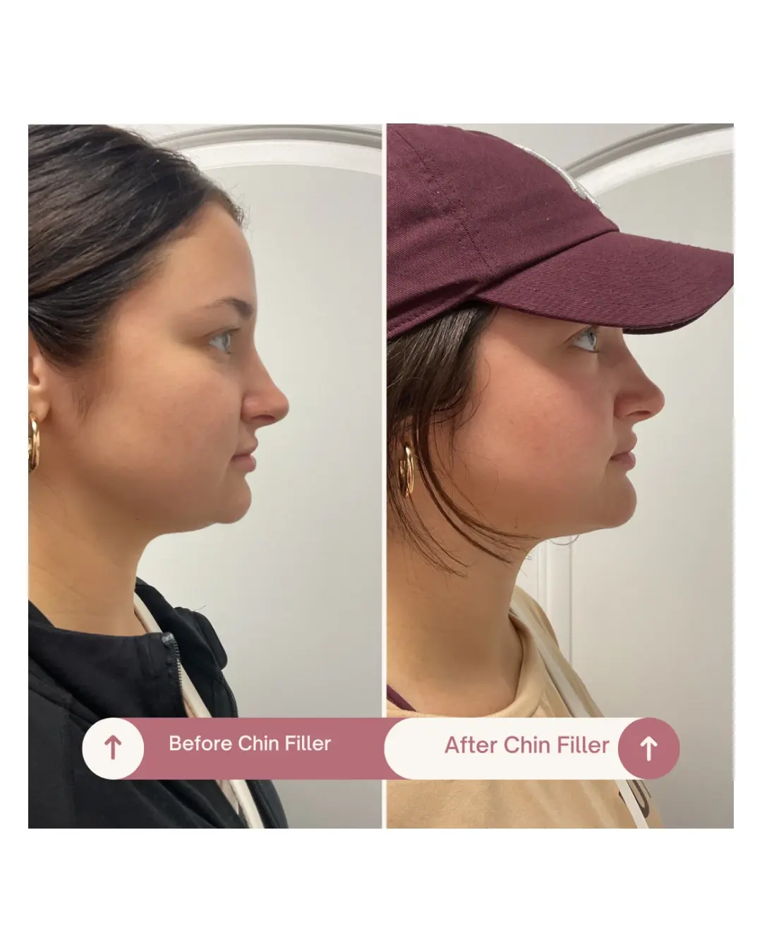 Relleno de mentón antes y después, perfil lateral