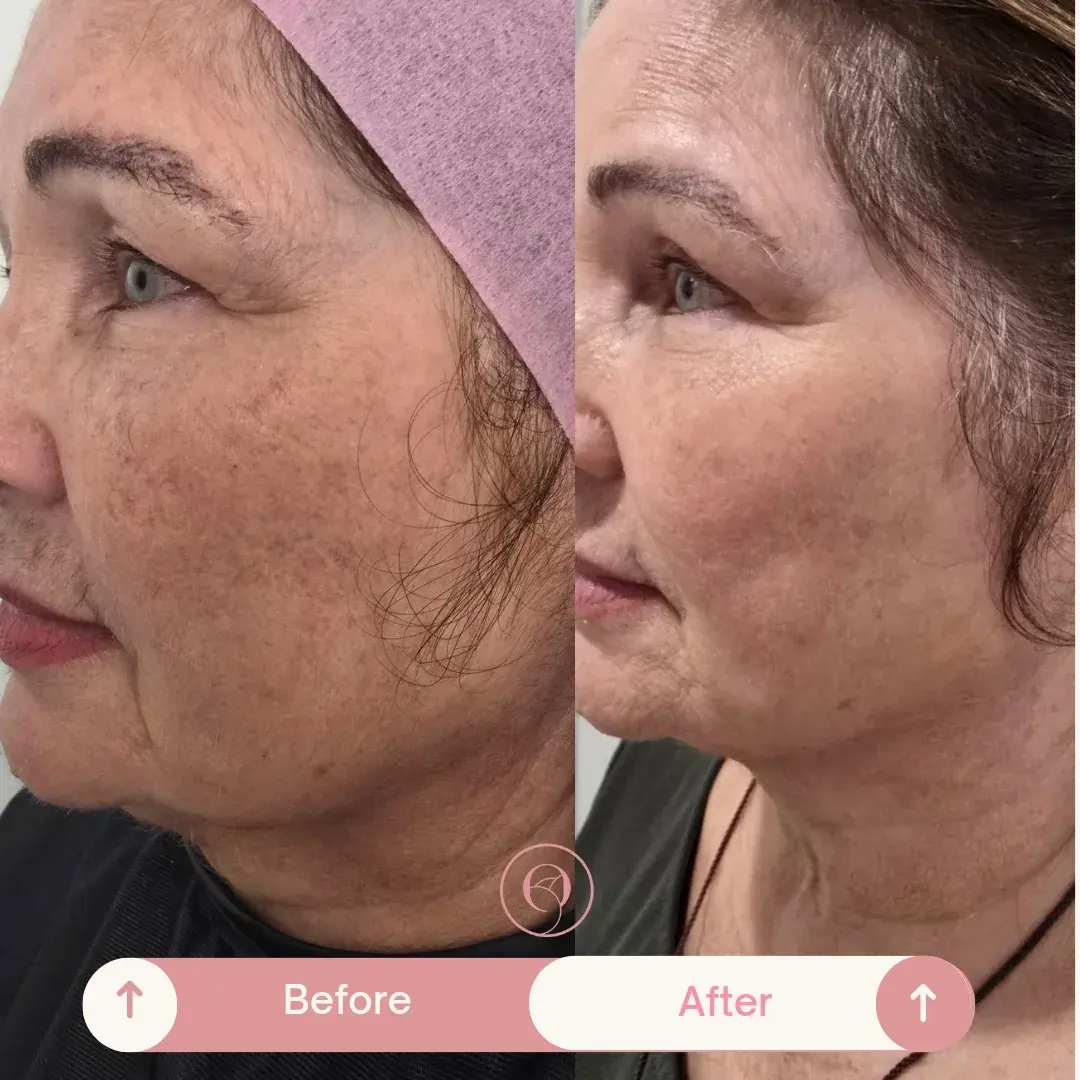 CoolPeel con láser de CO2 antes y después