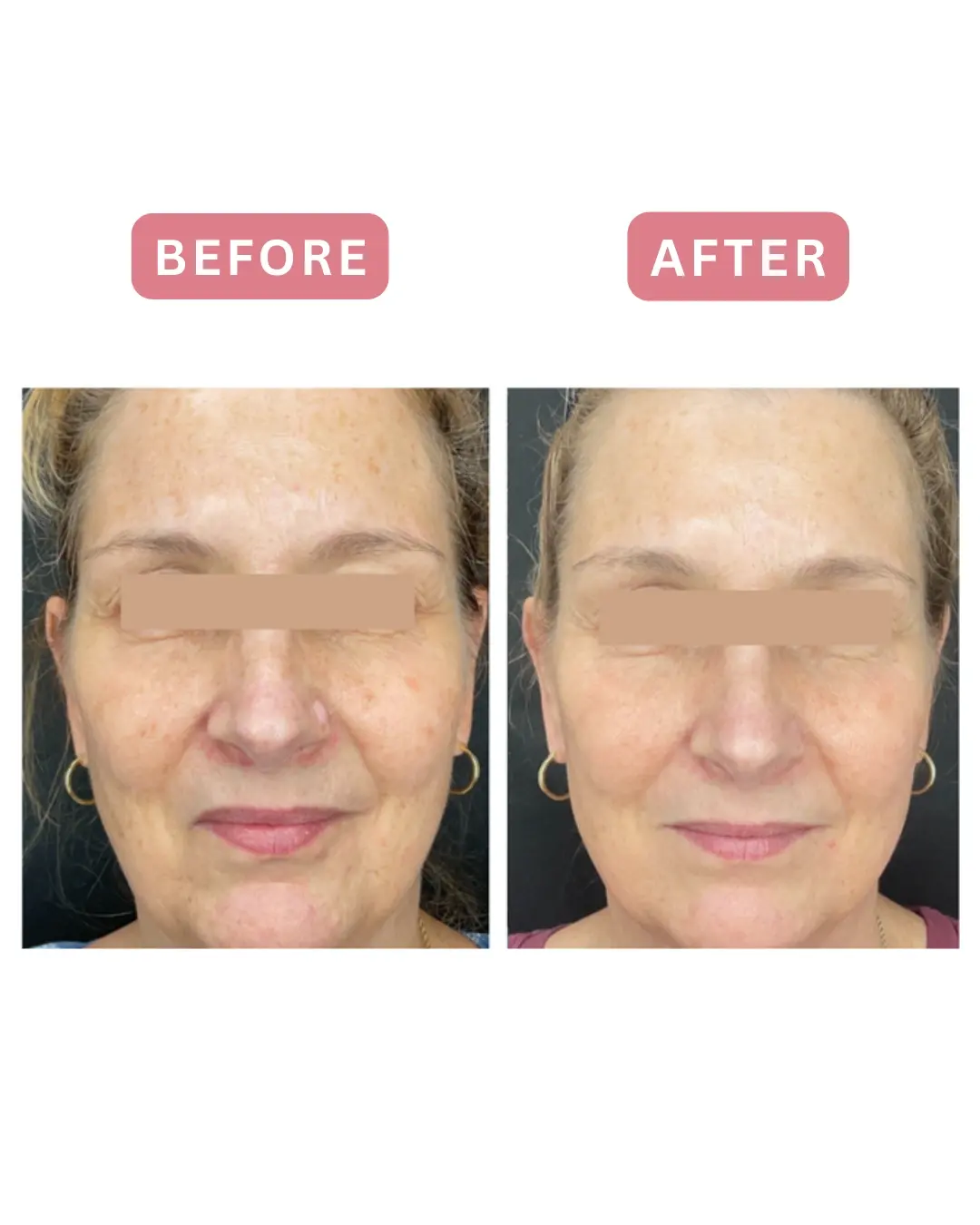 Antes y después del láser de CO2 CoolPeel, rostro completo