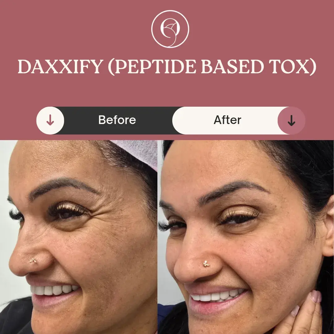 Daxxify antes y después