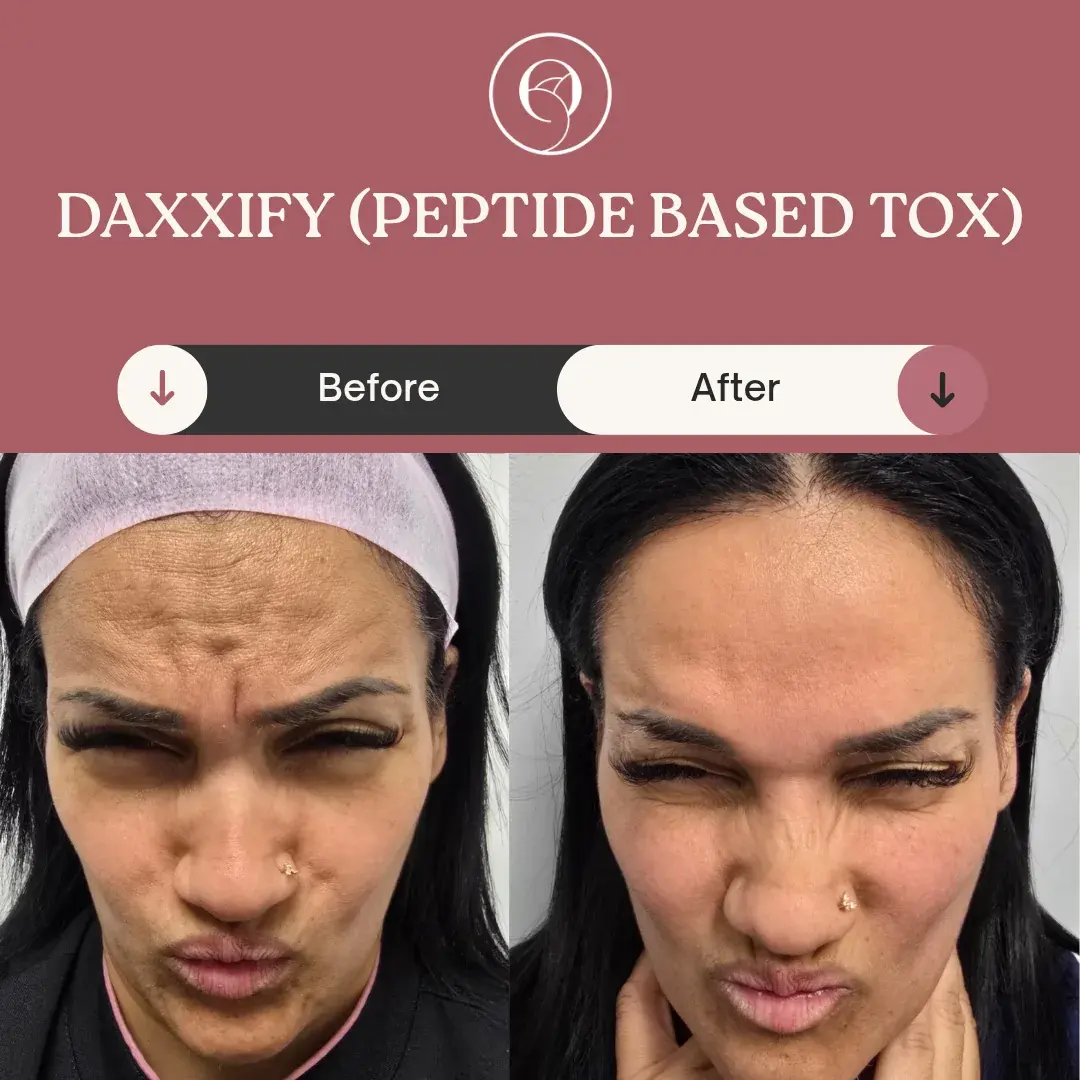Daxxify antes y después