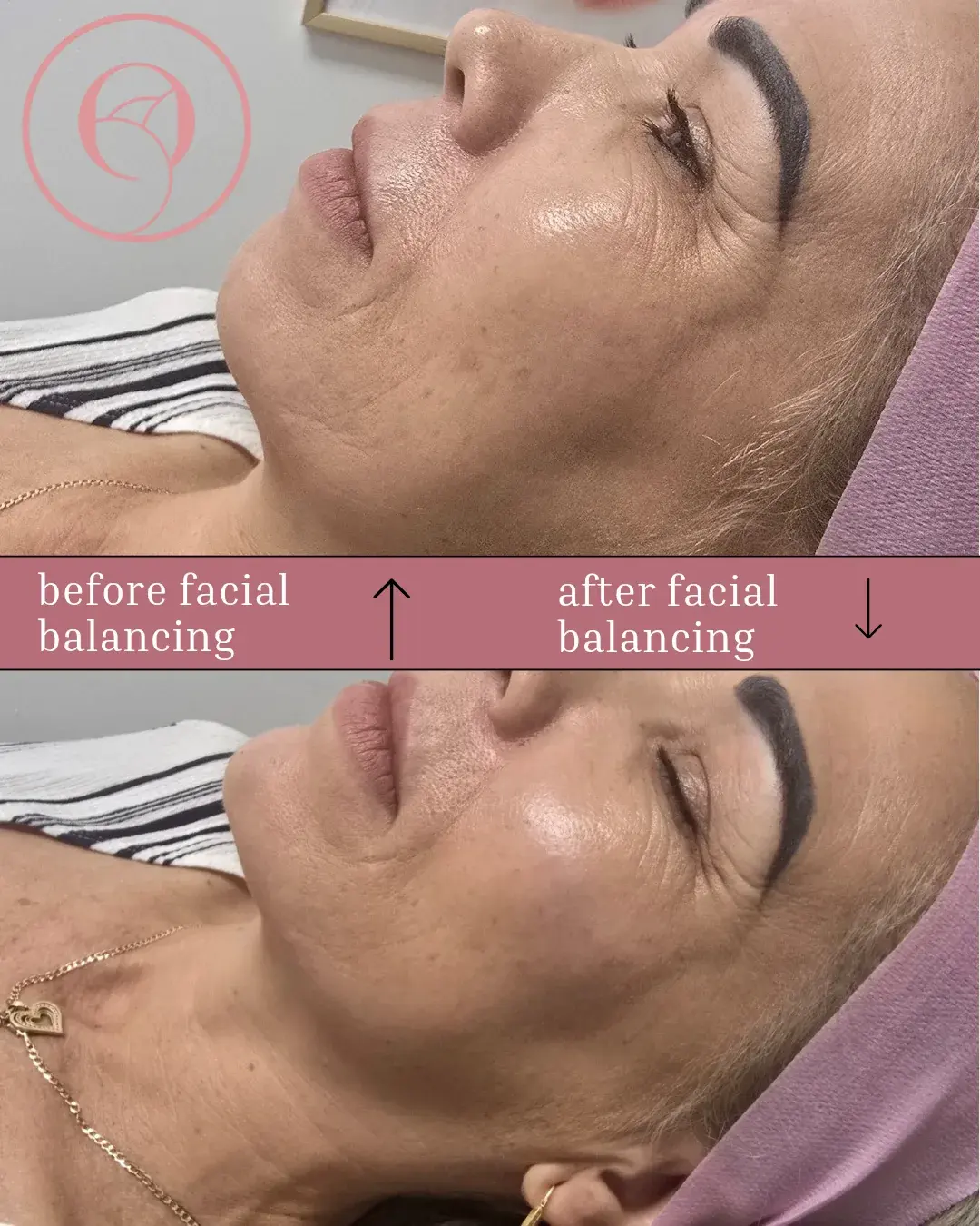 Equilibrio facial con relleno, antes y después