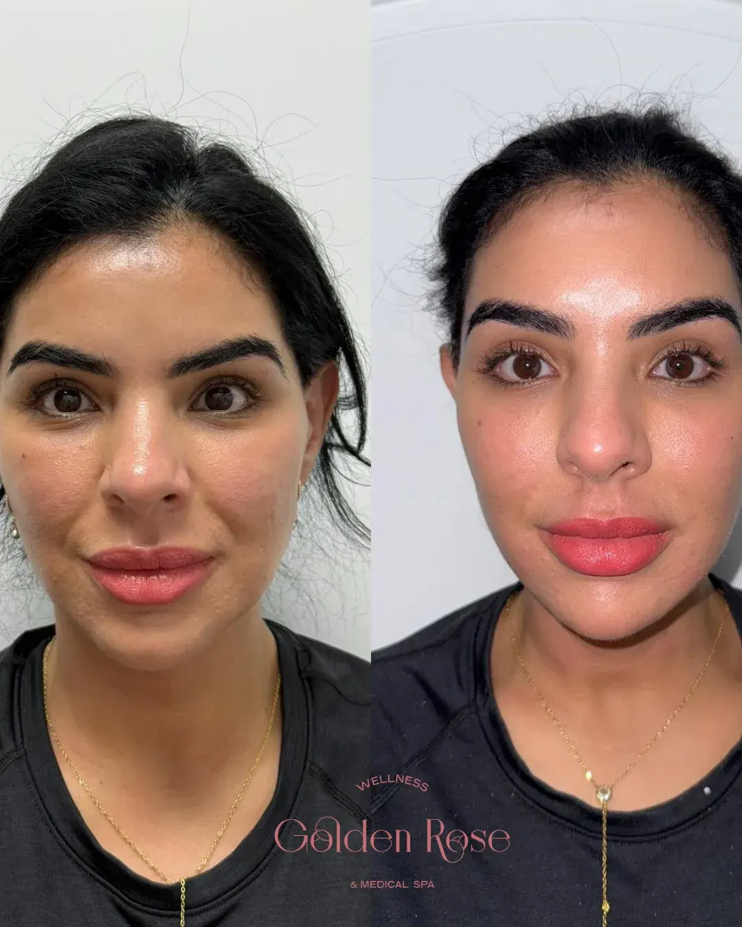 Equilibrio facial con relleno, antes y después