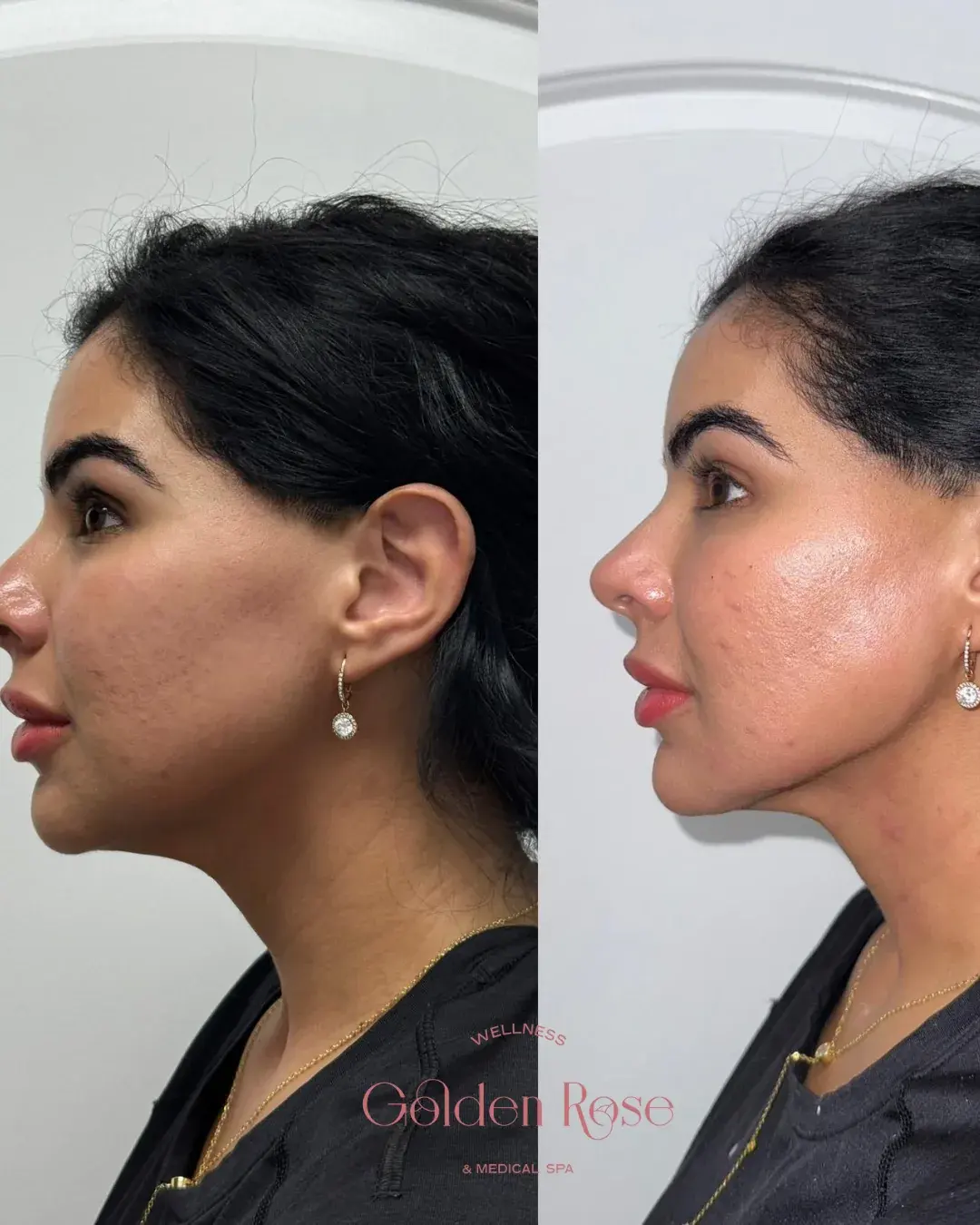 Equilibrio facial con relleno, antes y después