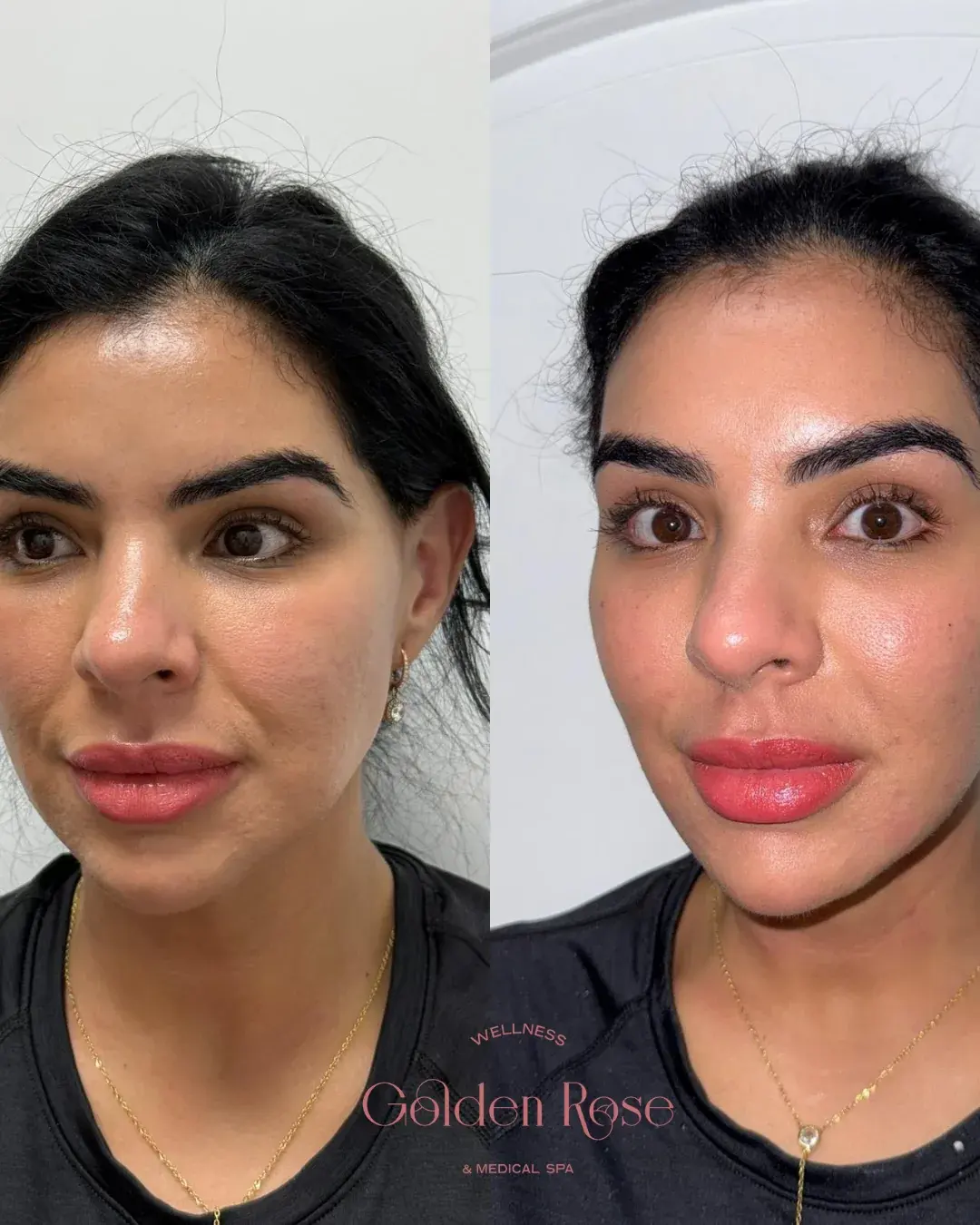 Equilibrio facial con relleno, antes y después