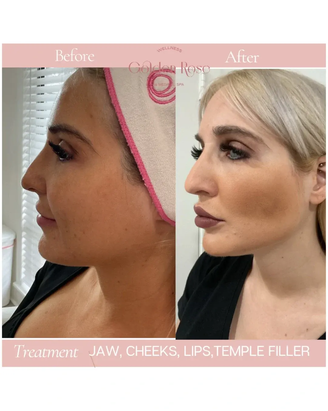 Equilibrio facial antes y después, relleno en mandíbula, pómulos, labios y sienes