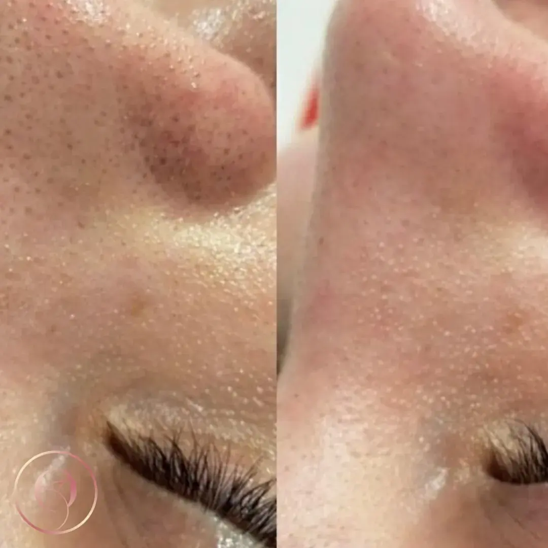 HydraFacial antes y después, poros de la nariz