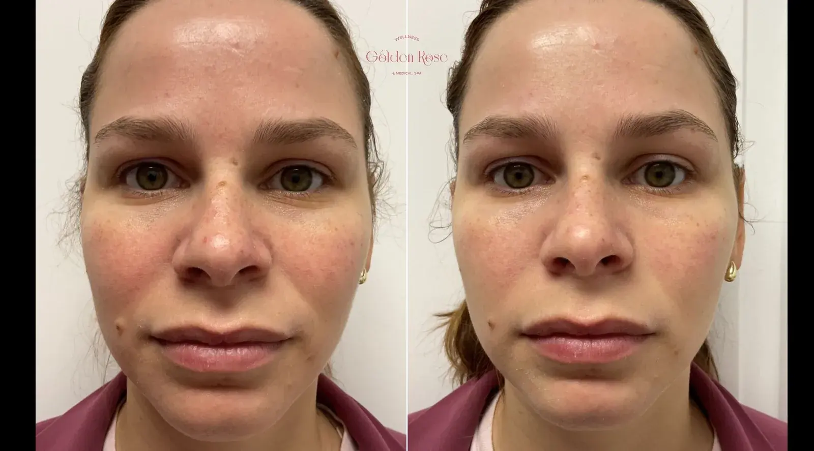 Fotofacial IPL antes y después