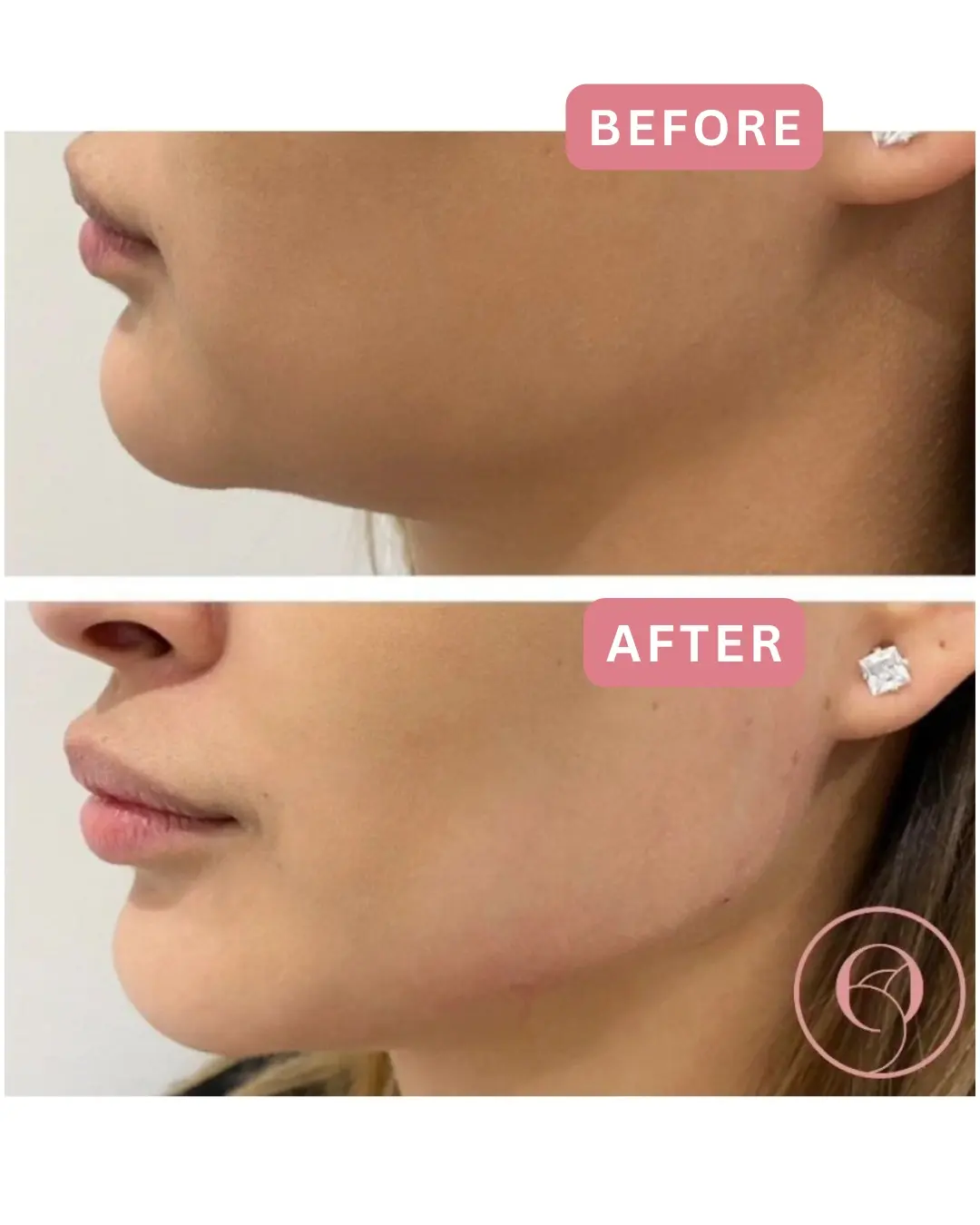 Relleno de mandíbula antes y después, perfil lateral