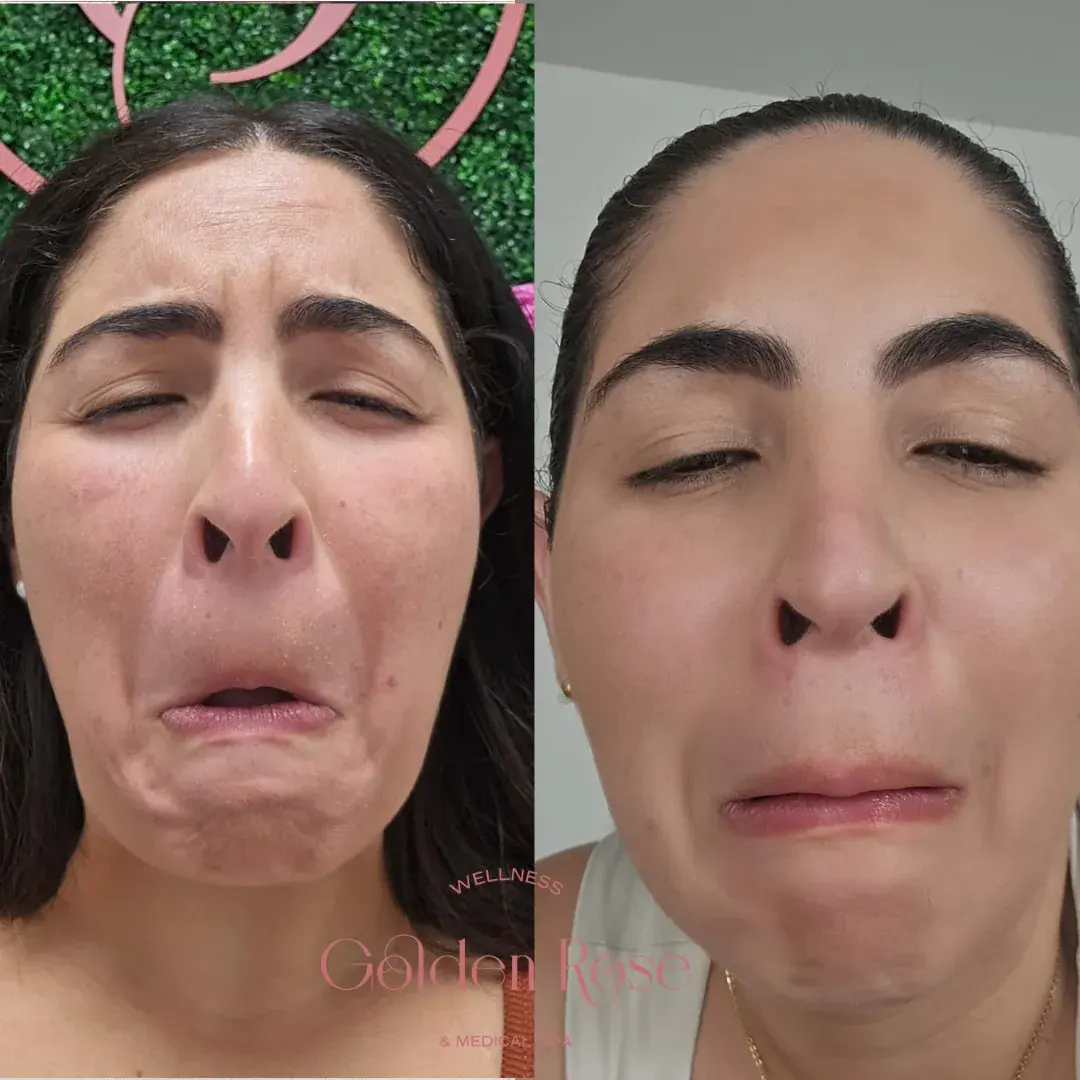 Jeuveau antes y después