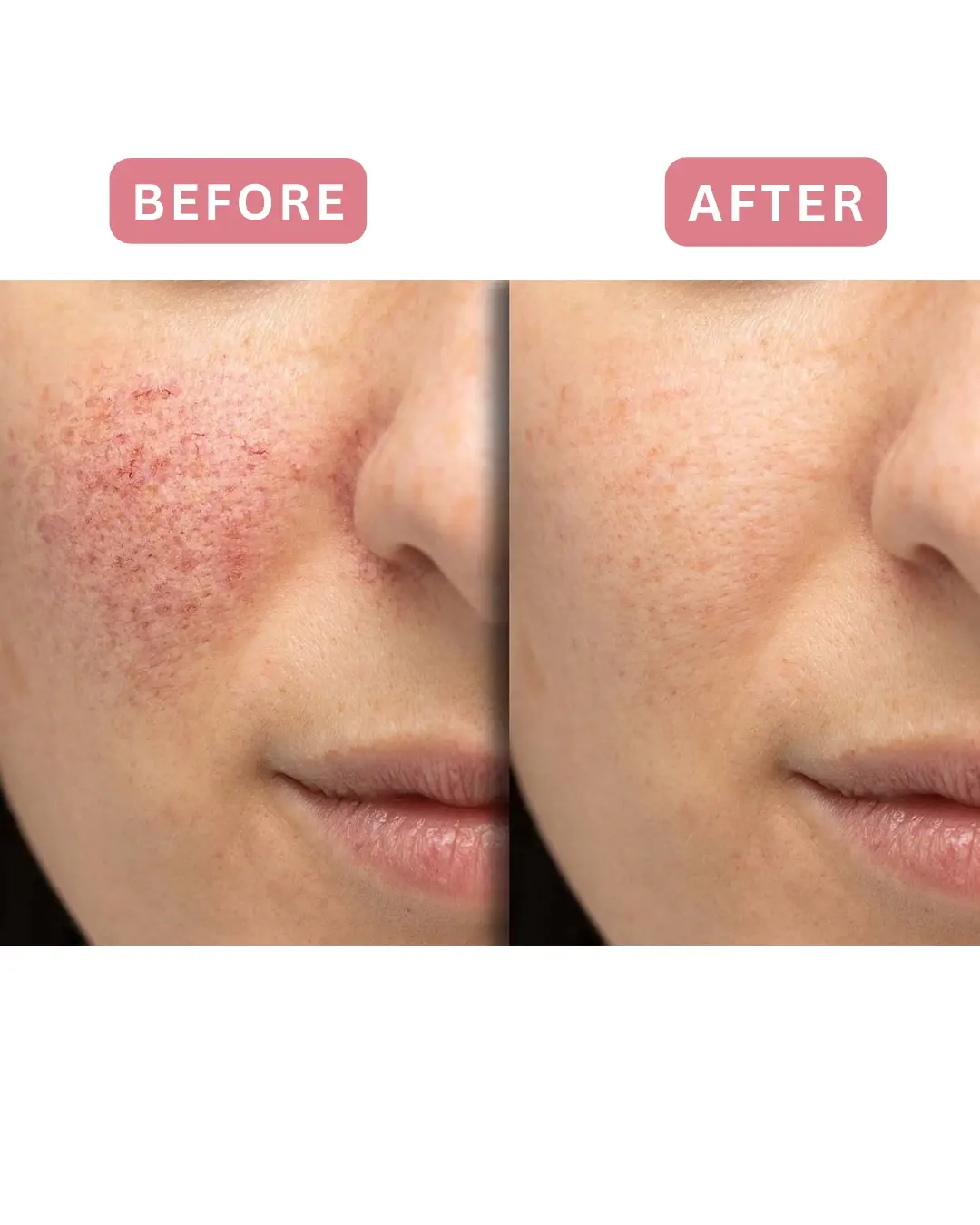 Láser antes y después, enrojecimiento facial