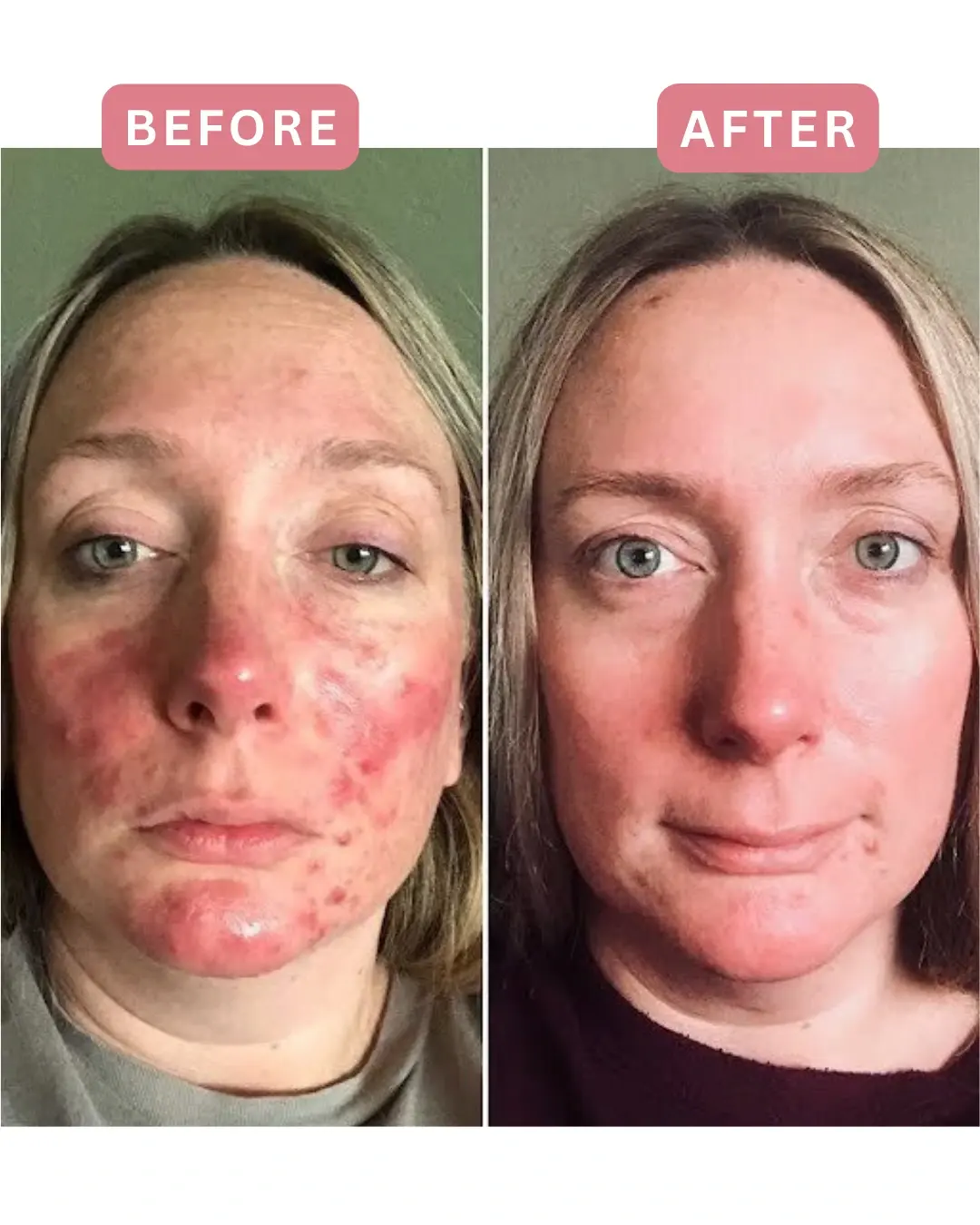 Tratamiento láser para la rosácea, antes y después
