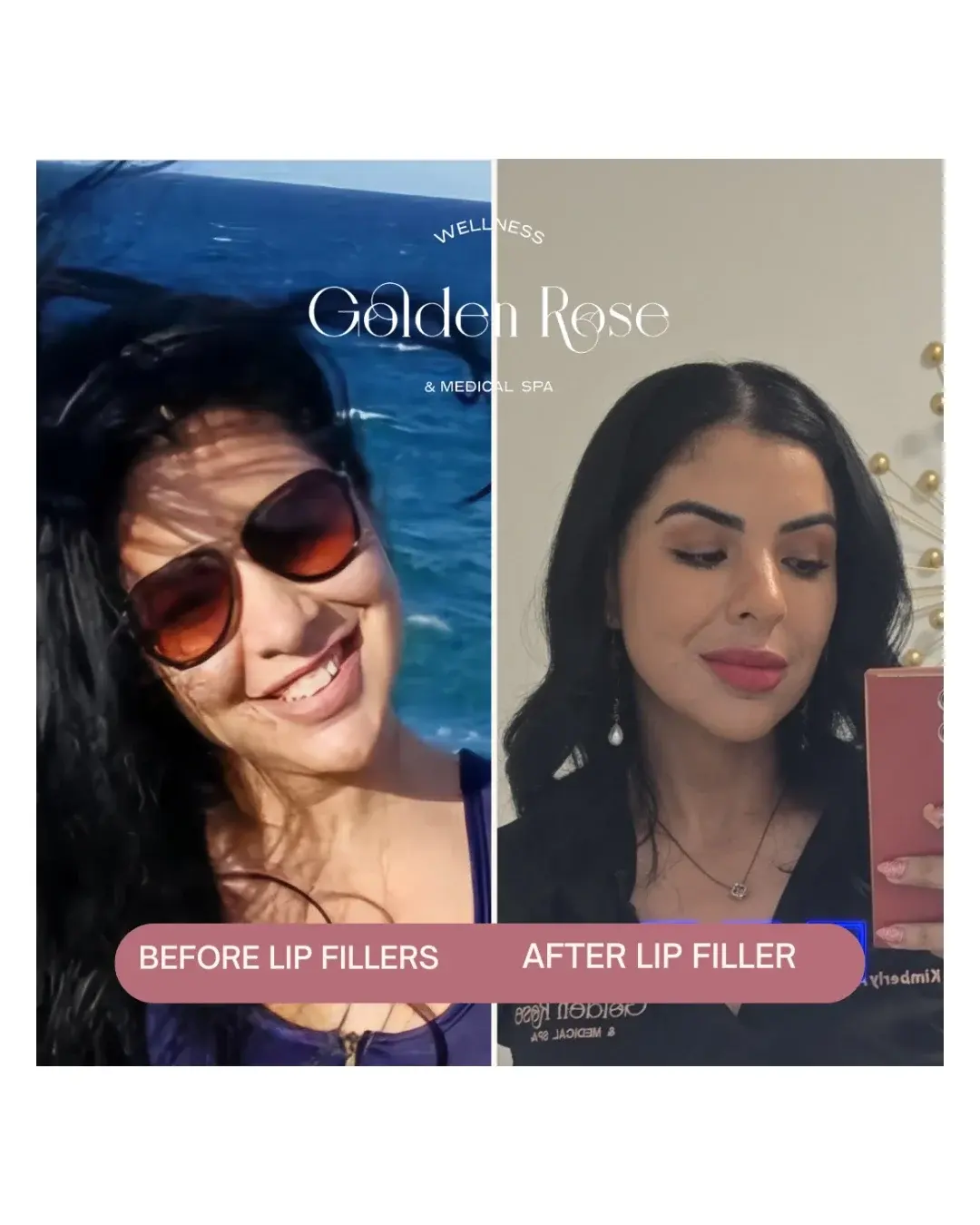 Relleno de labios antes y después