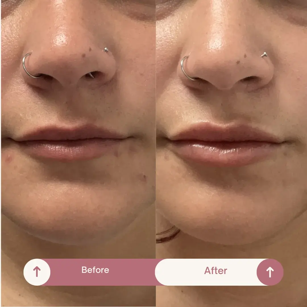 Relleno de labios antes y después