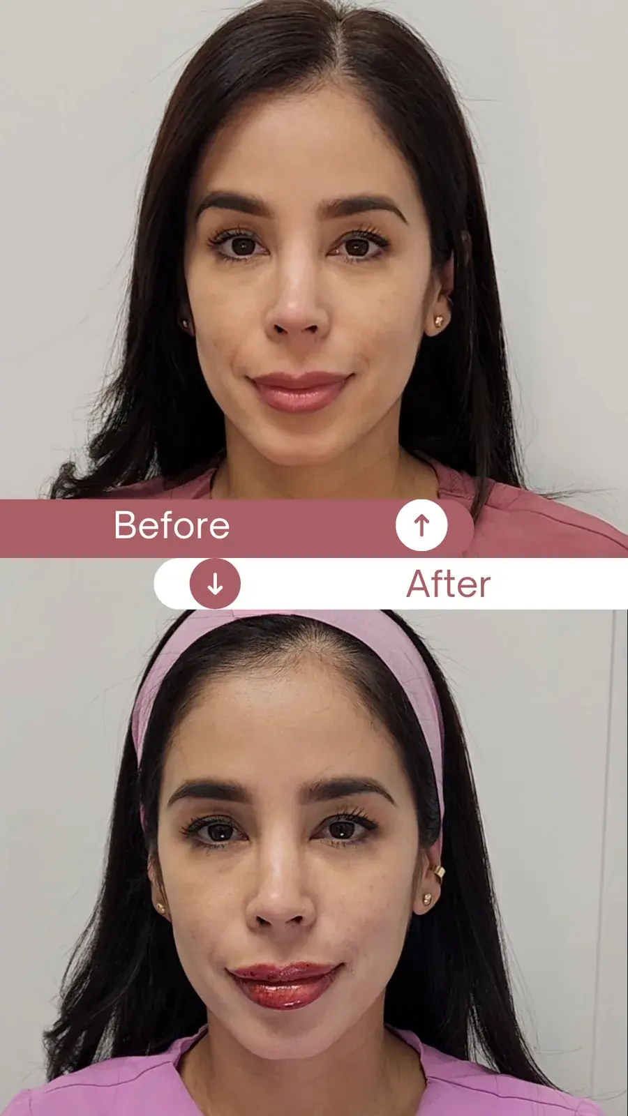 Relleno de labios antes y después