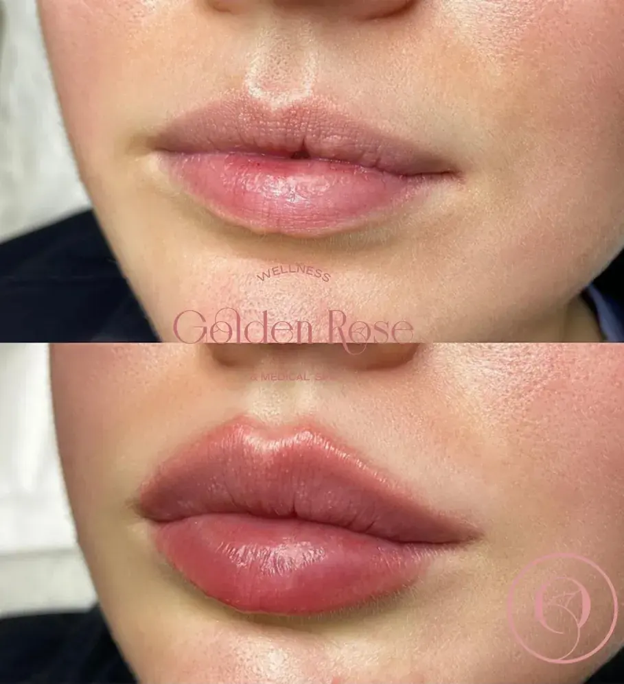 Relleno de labios antes y después