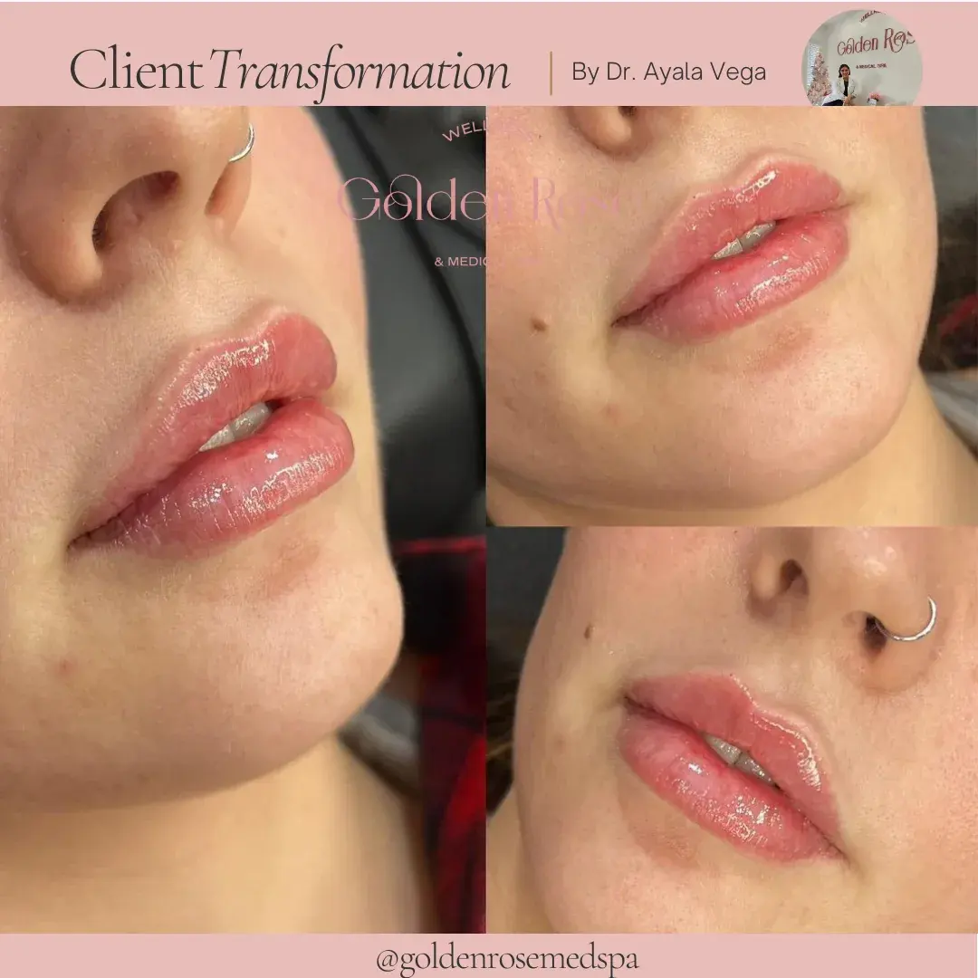 Relleno de labios antes y después