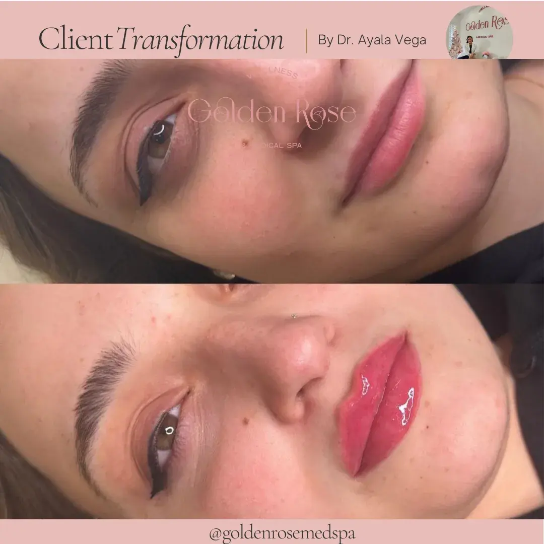 Relleno de labios antes y después