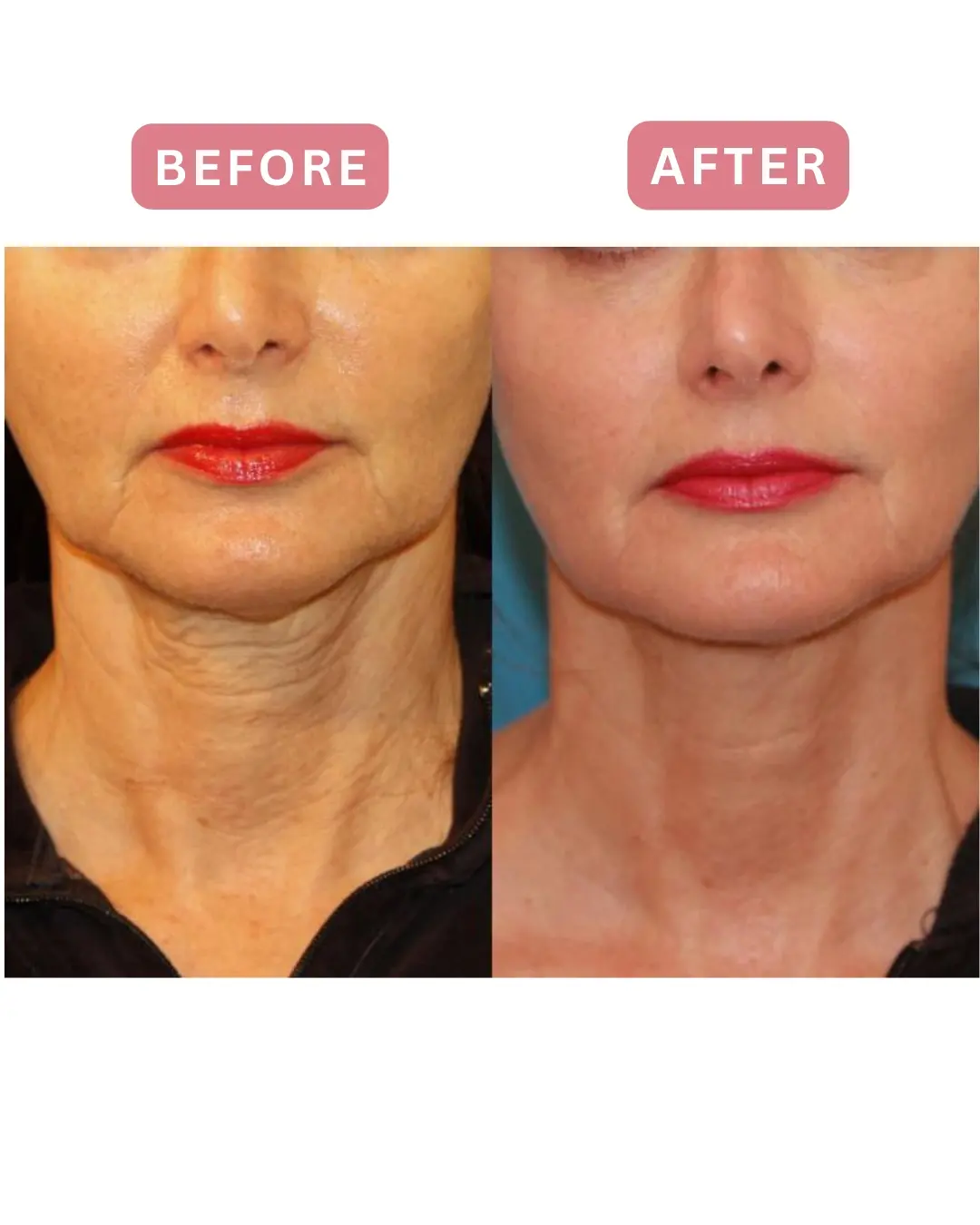 Antes y después, parte baja del rostro y cuello