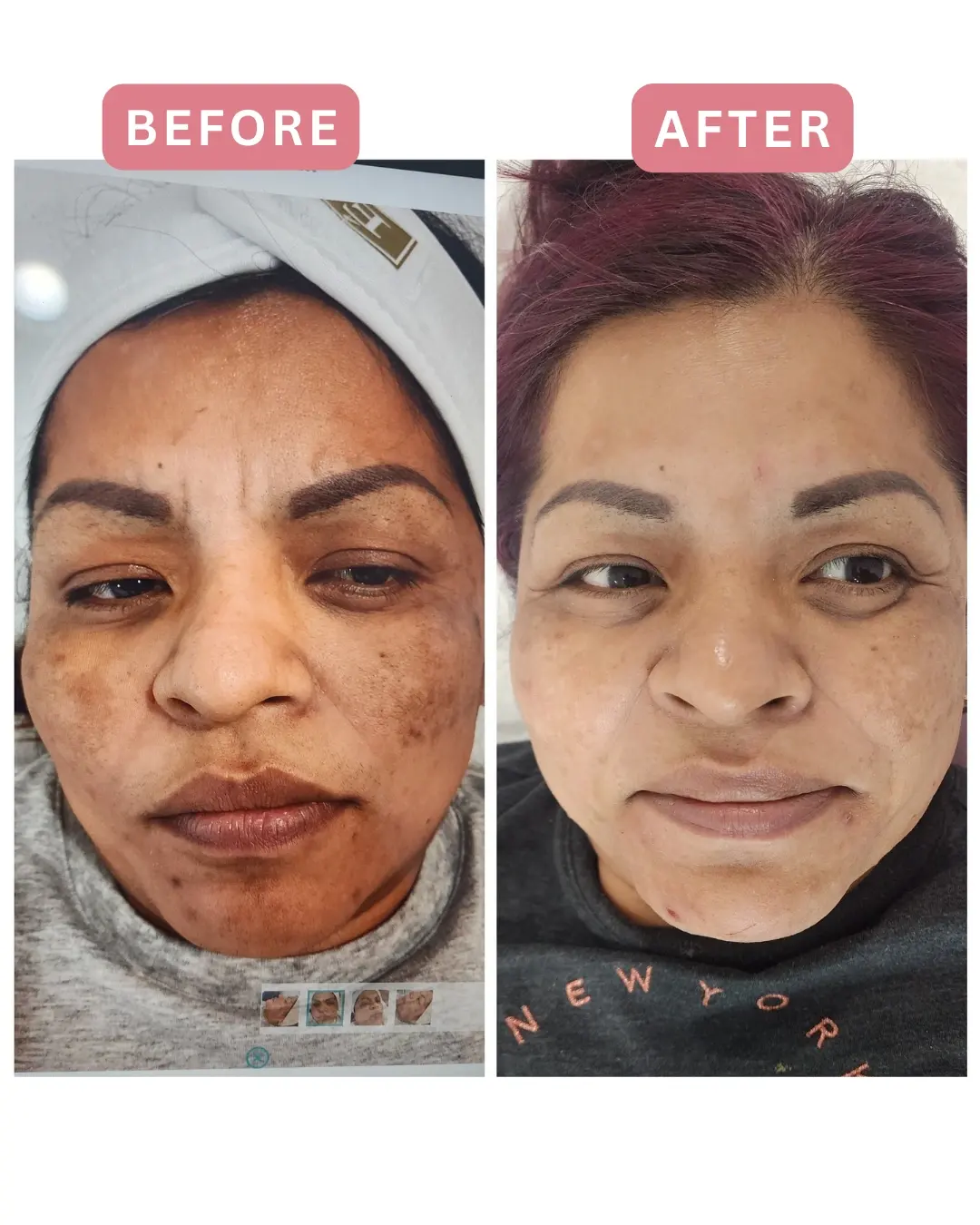 Tratamiento para el melasma, antes y después