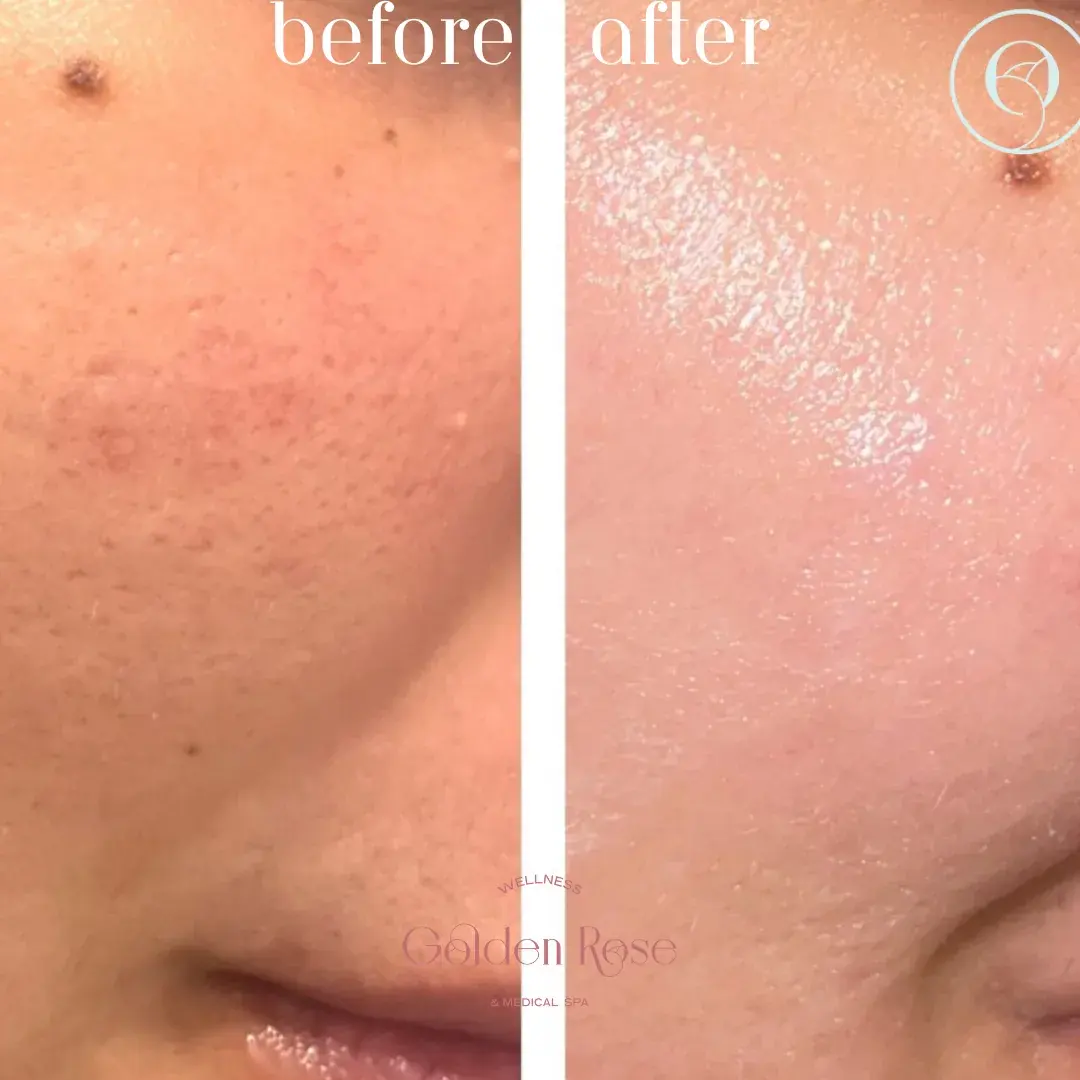 Microneedling antes y después