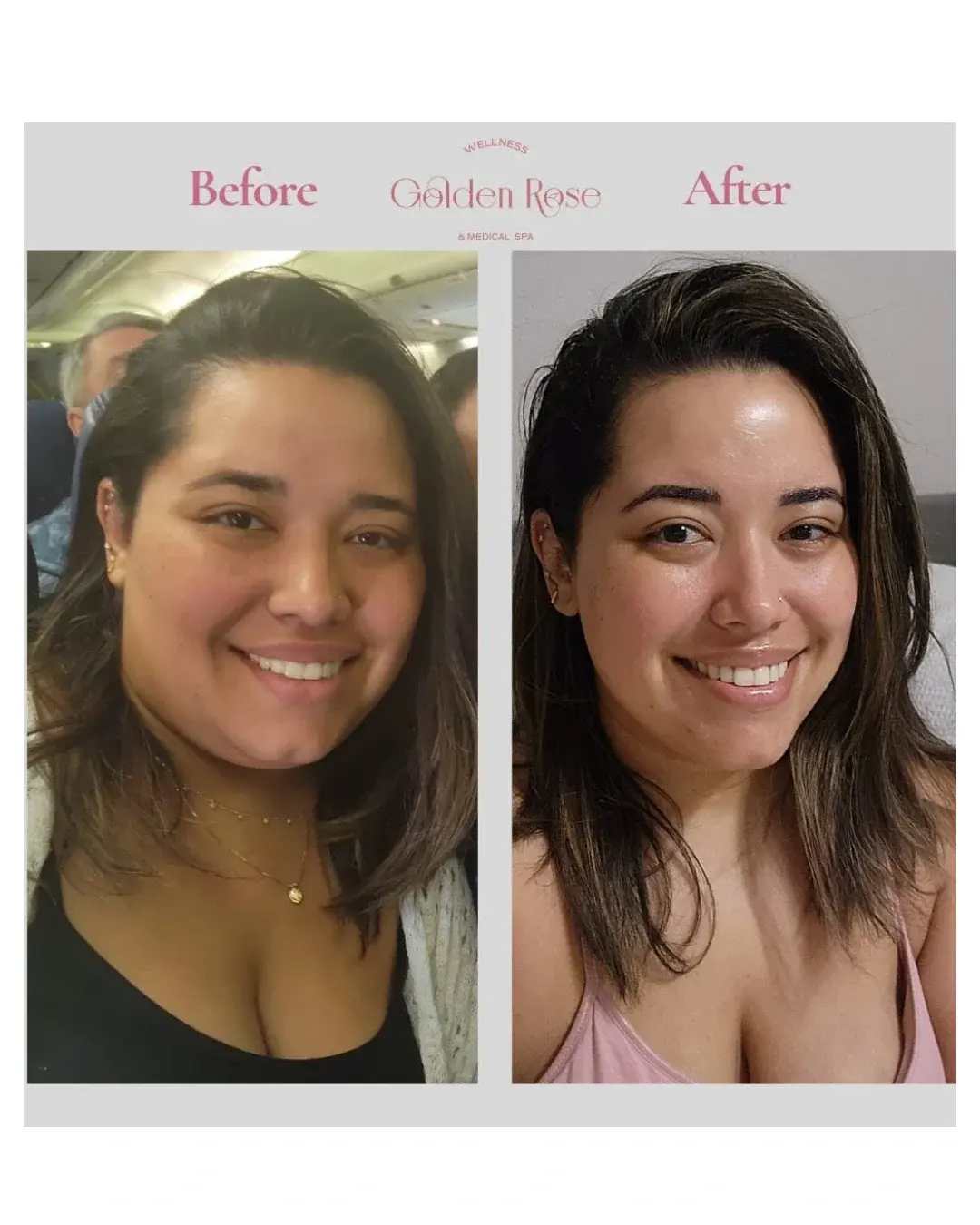 Antes y después de paciente de Golden Rose