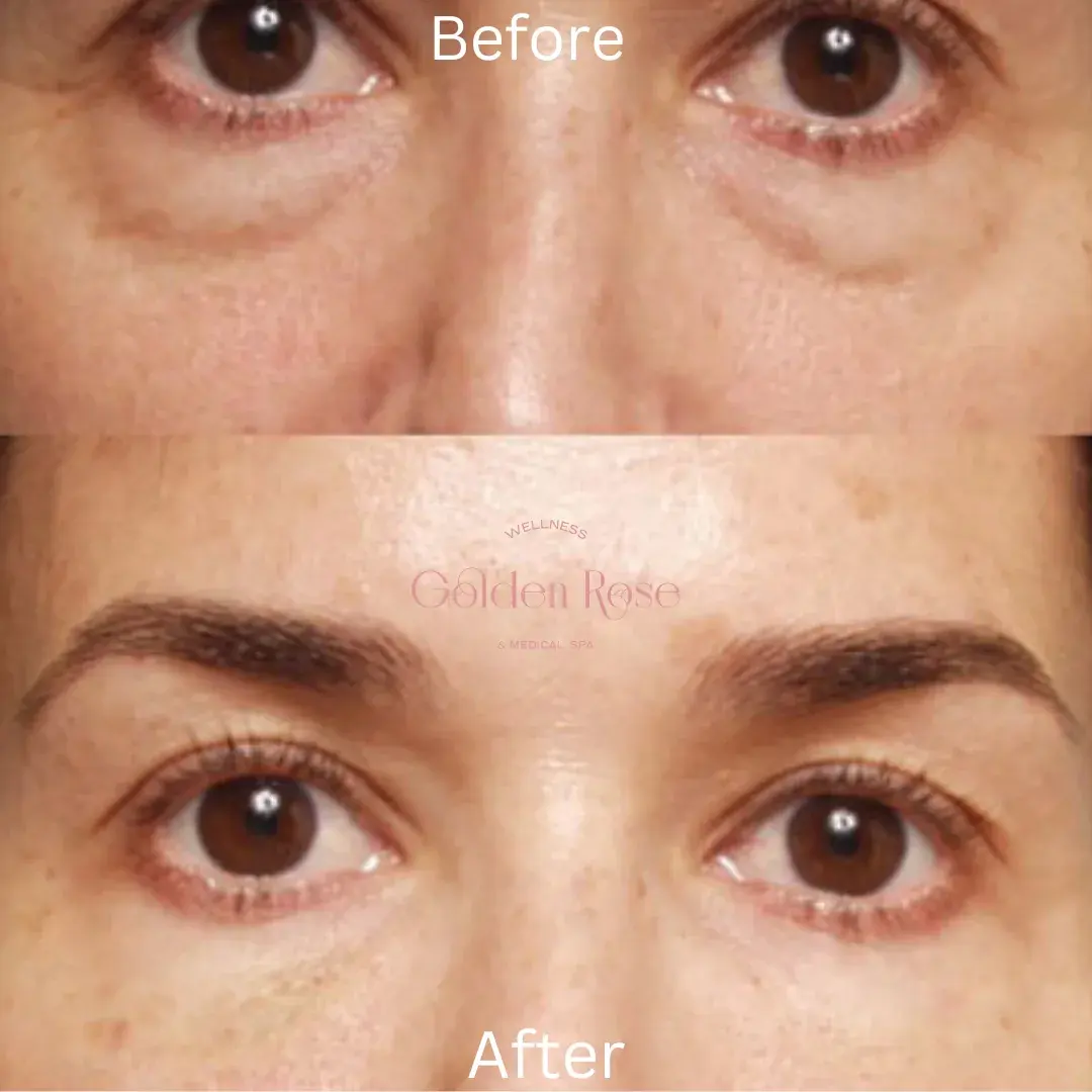 Tratamiento con PDGF debajo de los ojos antes y después