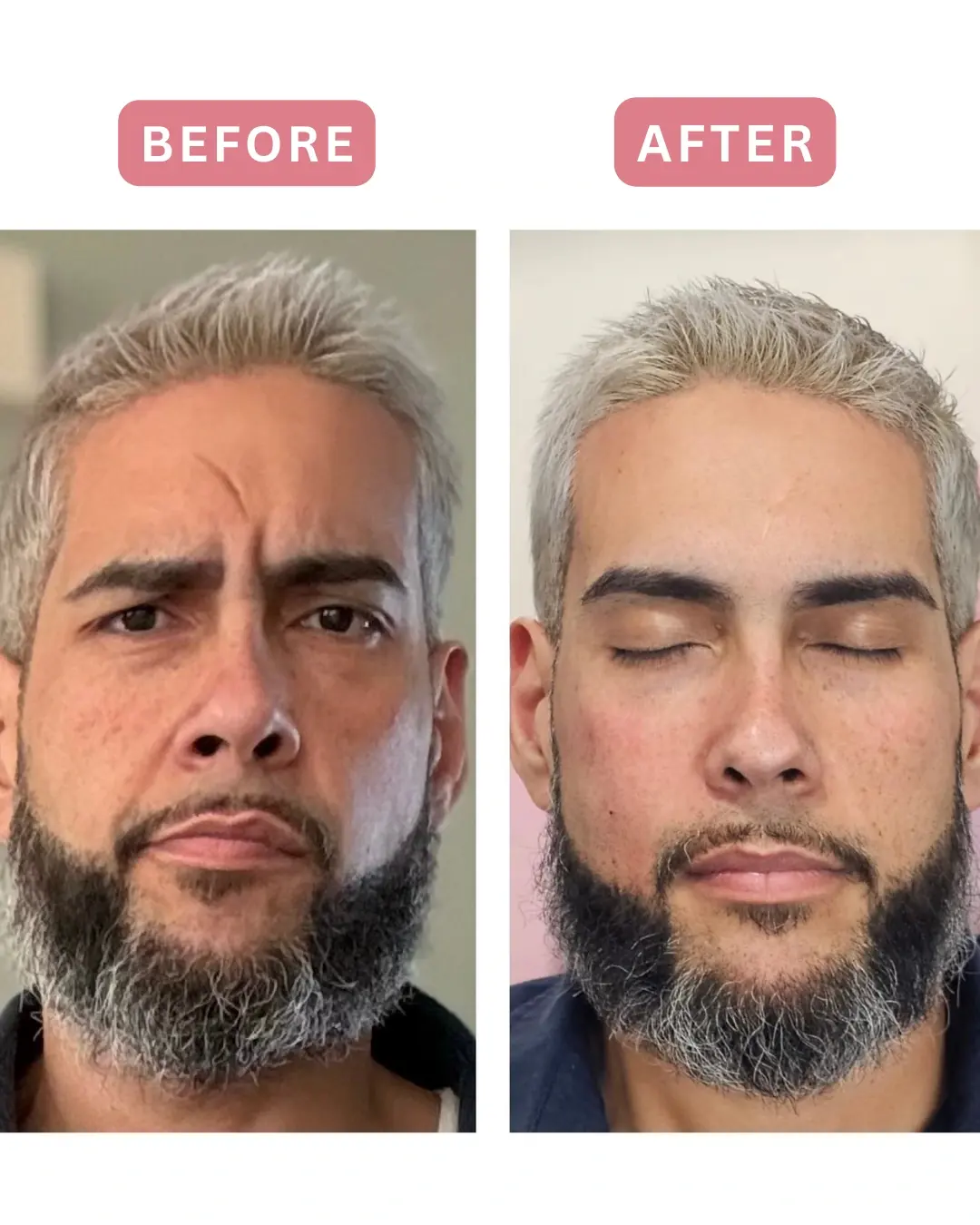 Antes y después de Sculptra, rostro completo