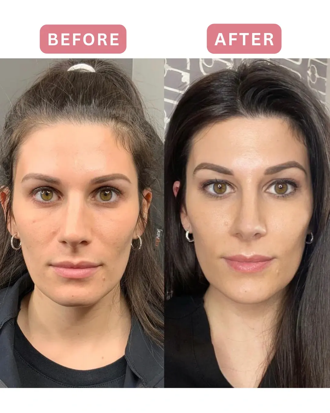 Antes y después de Sculptra, rostro completo
