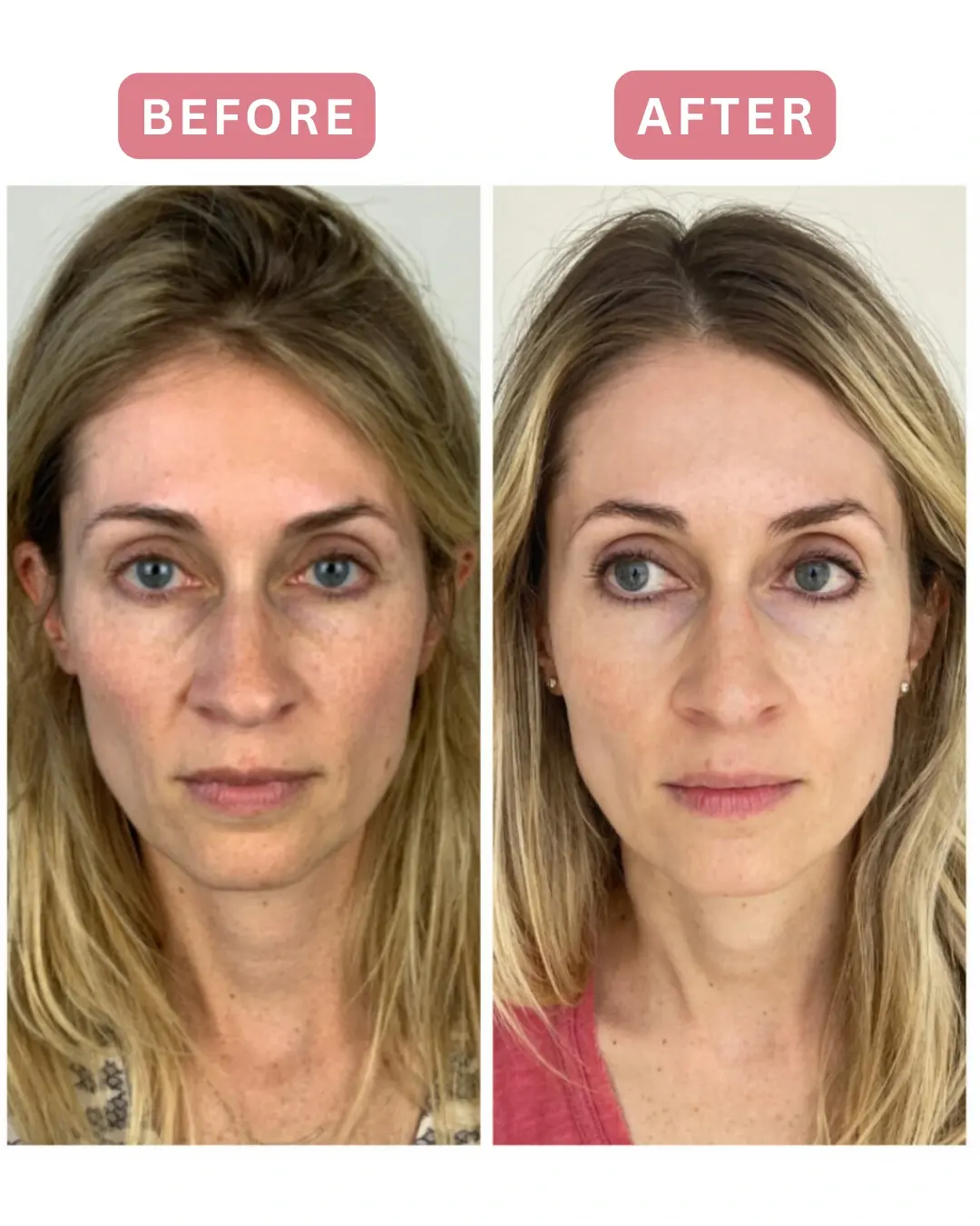 Antes y después de Sculptra, rostro completo