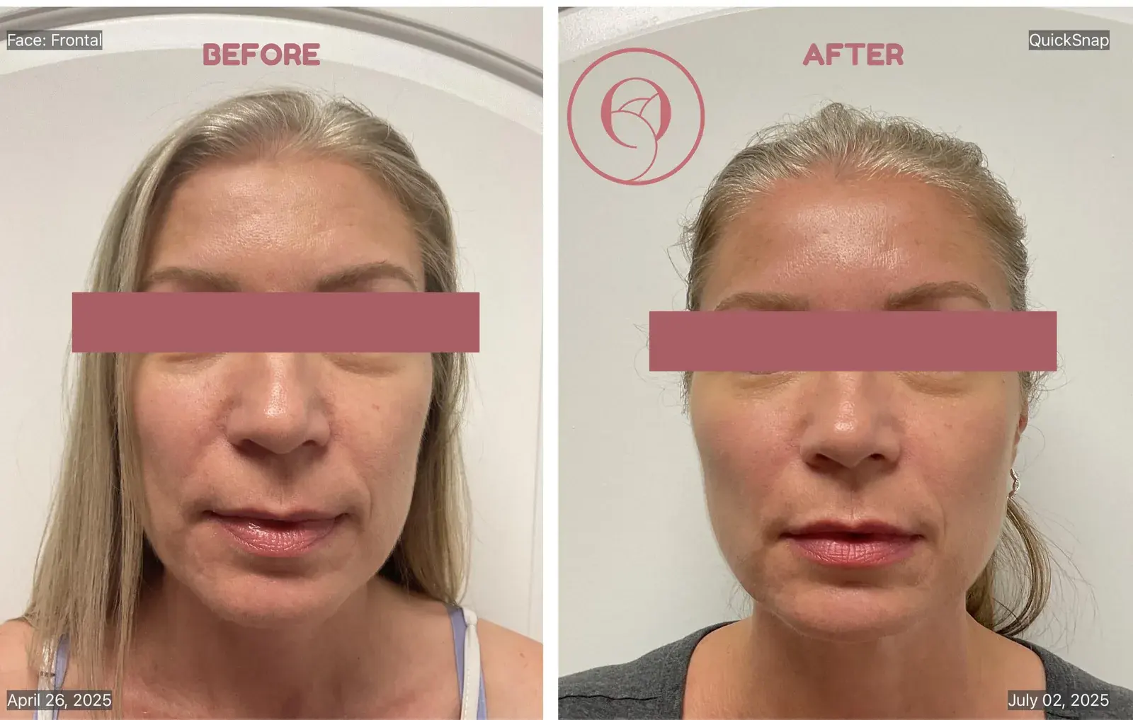 Sculptra antes y después