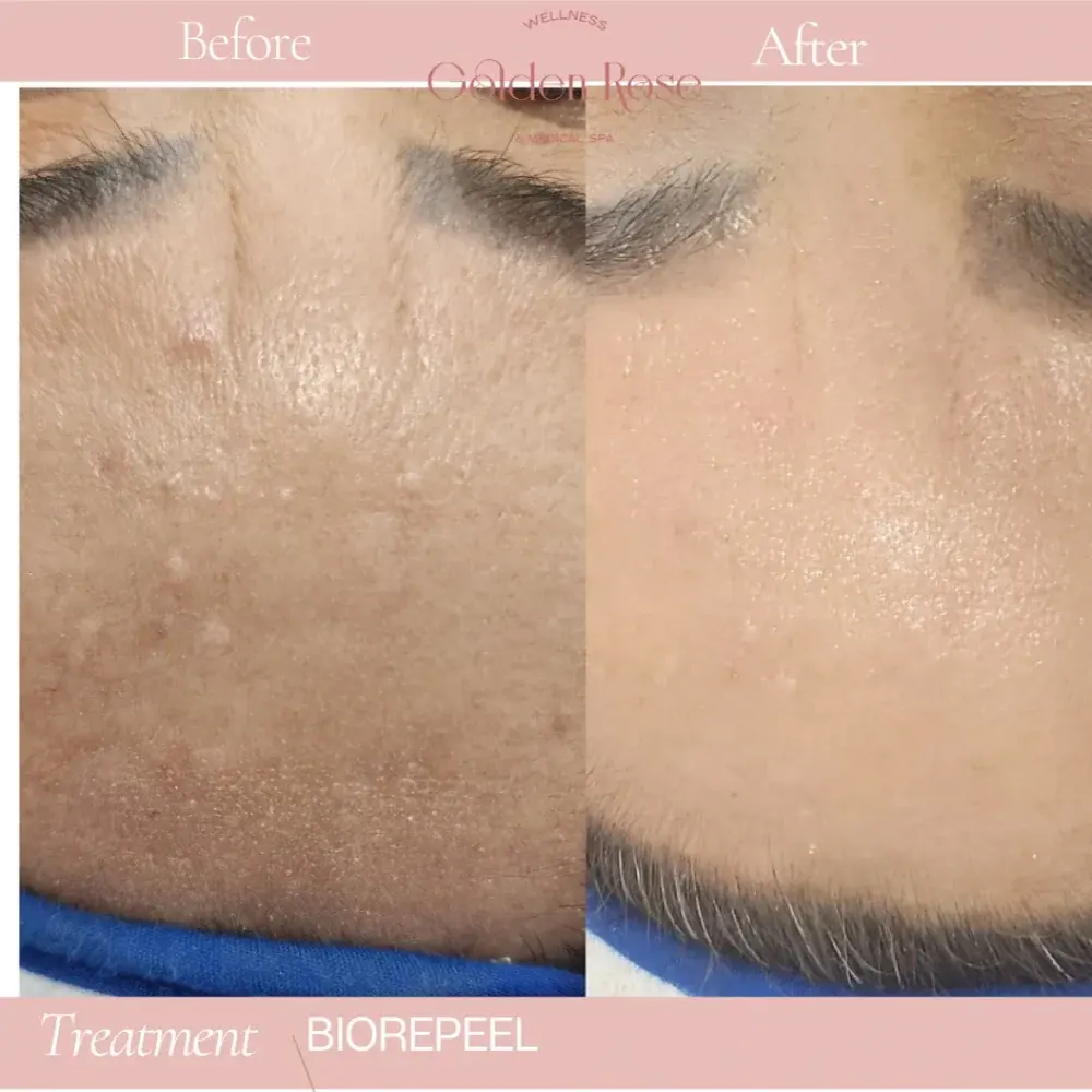 BioRePeel before and after, skin texture