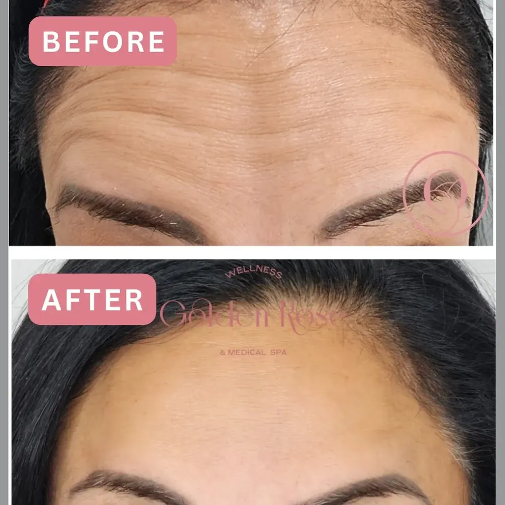 Botox before and after, forehead lines softened