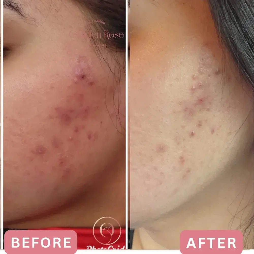 Chemical peel before and after, active acne