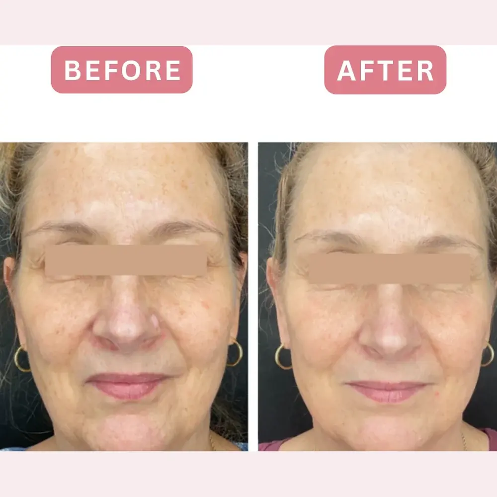 CoolPeel CO2 laser before and after, full face