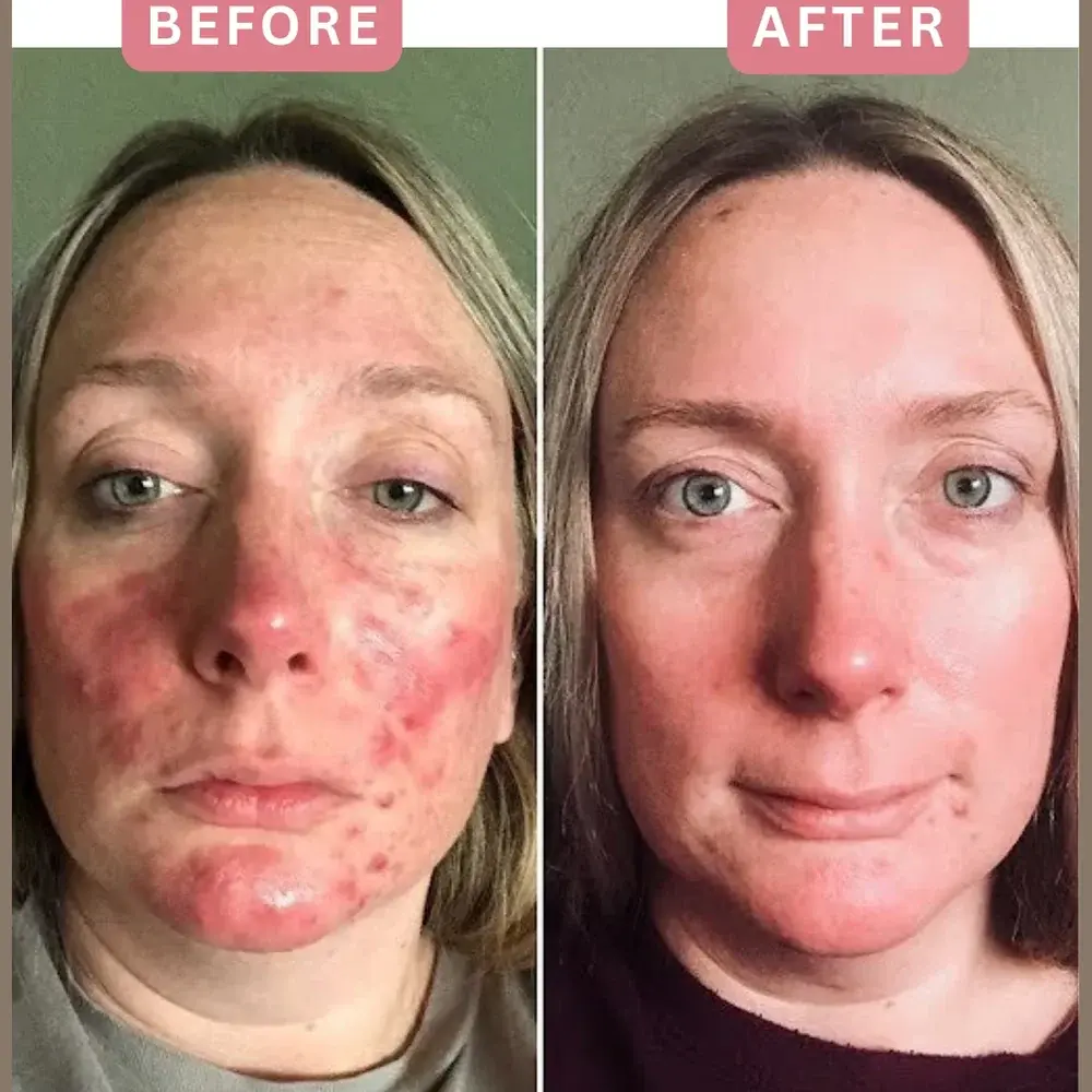 IPL before and after, redness and sun damage reduced