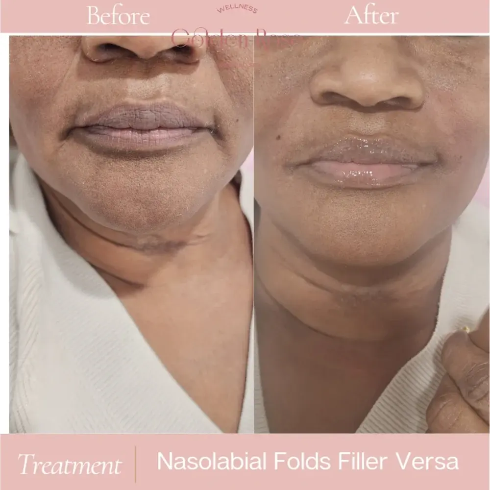Nasolabial fold filler before and after