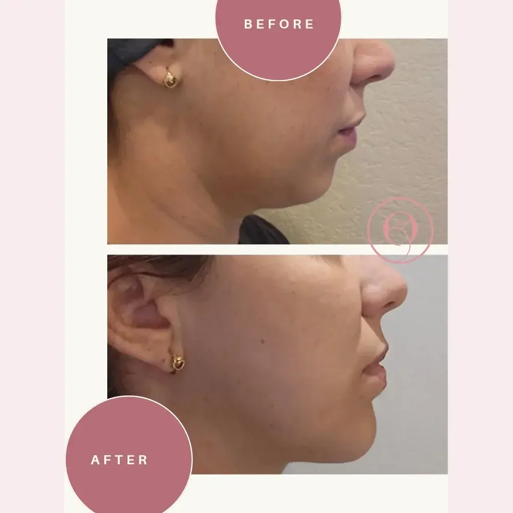 PCDC before and after, fullness under the chin reduced