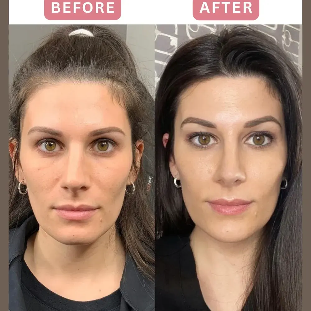 Sculptra before and after, full face