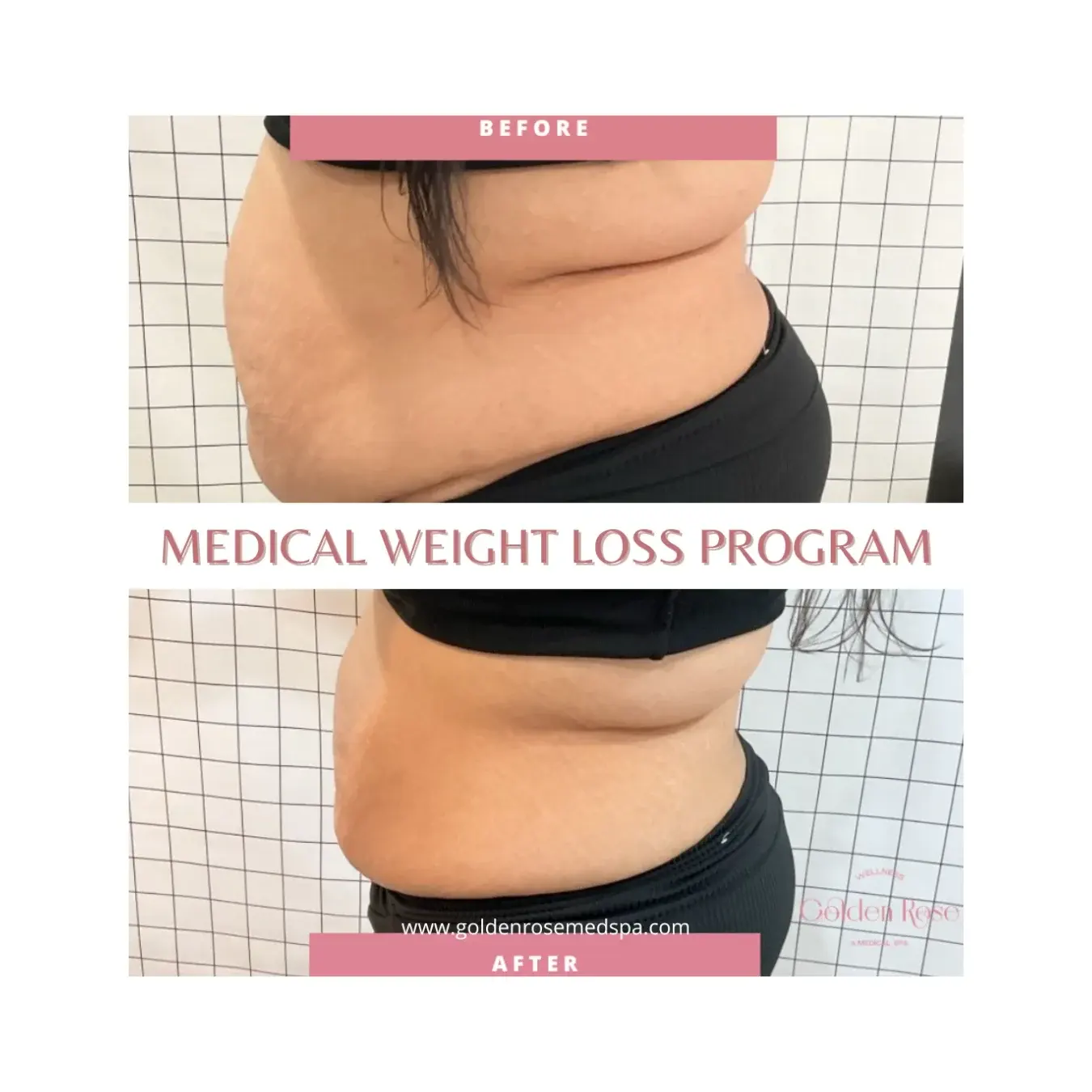 Golden Rose weight loss program patient, before and after