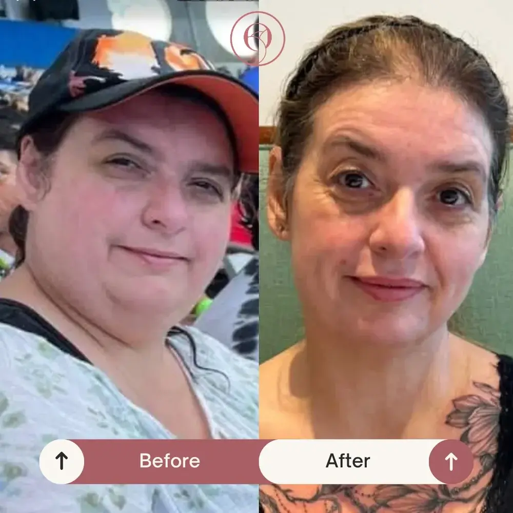 Medical weight loss before and after at Golden Rose, a patient's face slimmer through the cheeks and jaw