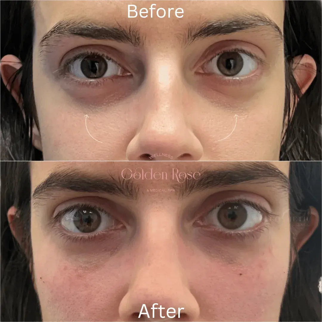 Tratamiento debajo de los ojos antes y después