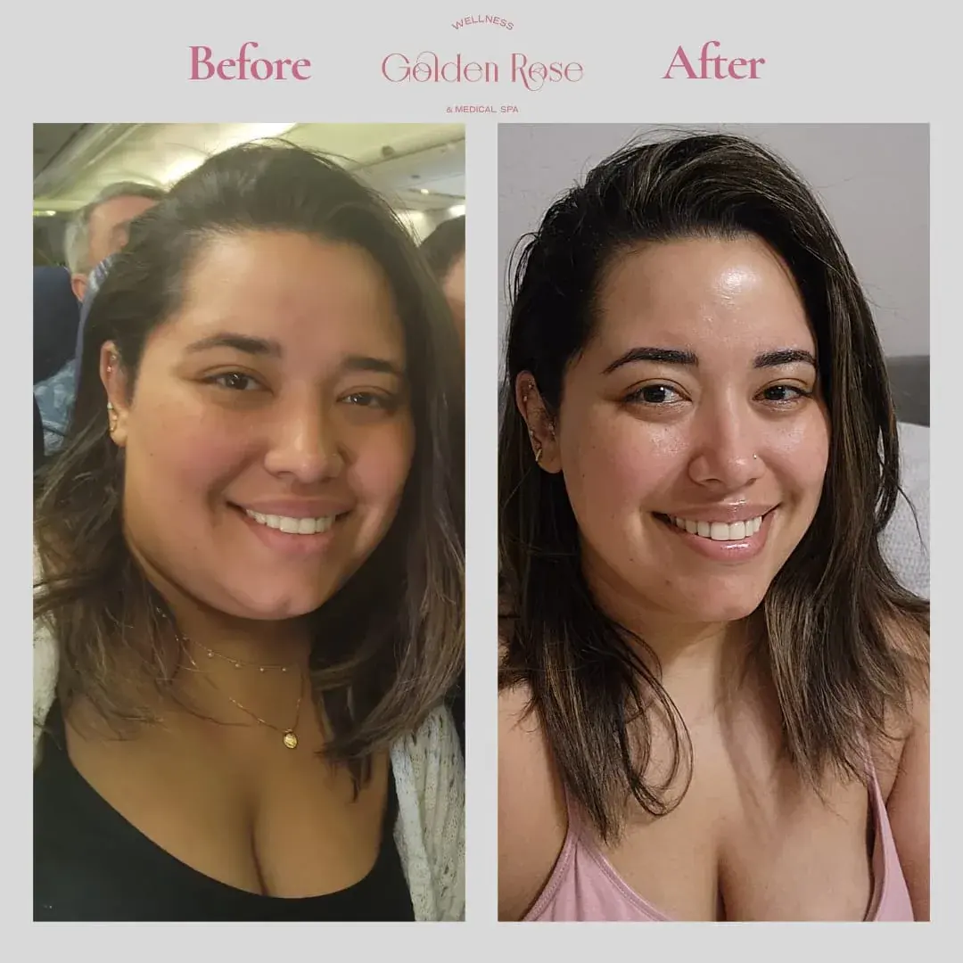 Pérdida de peso médica antes y después, rostro